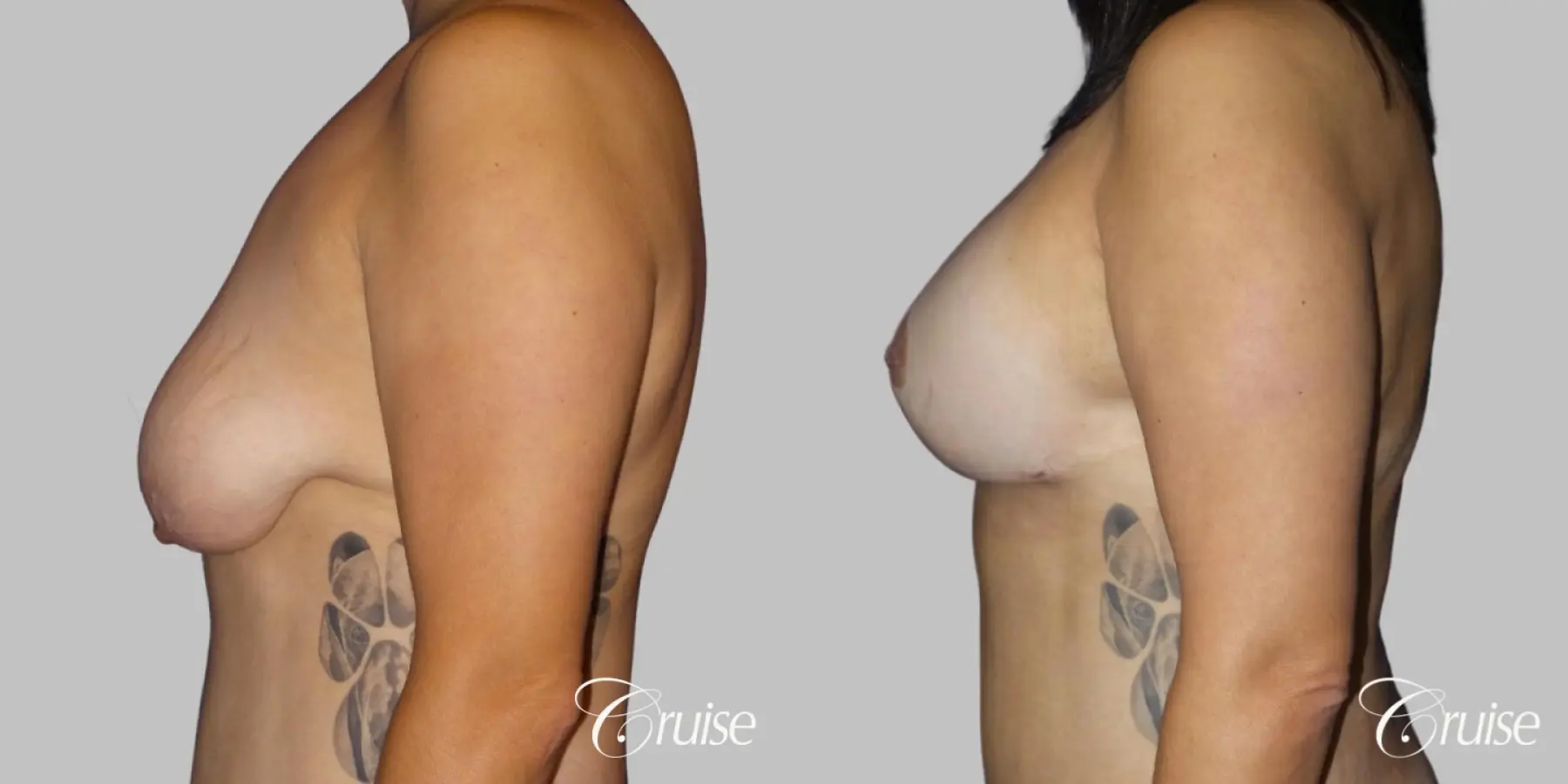 Breast Lift - Anchor with Saline Augmentation - Before and After 3