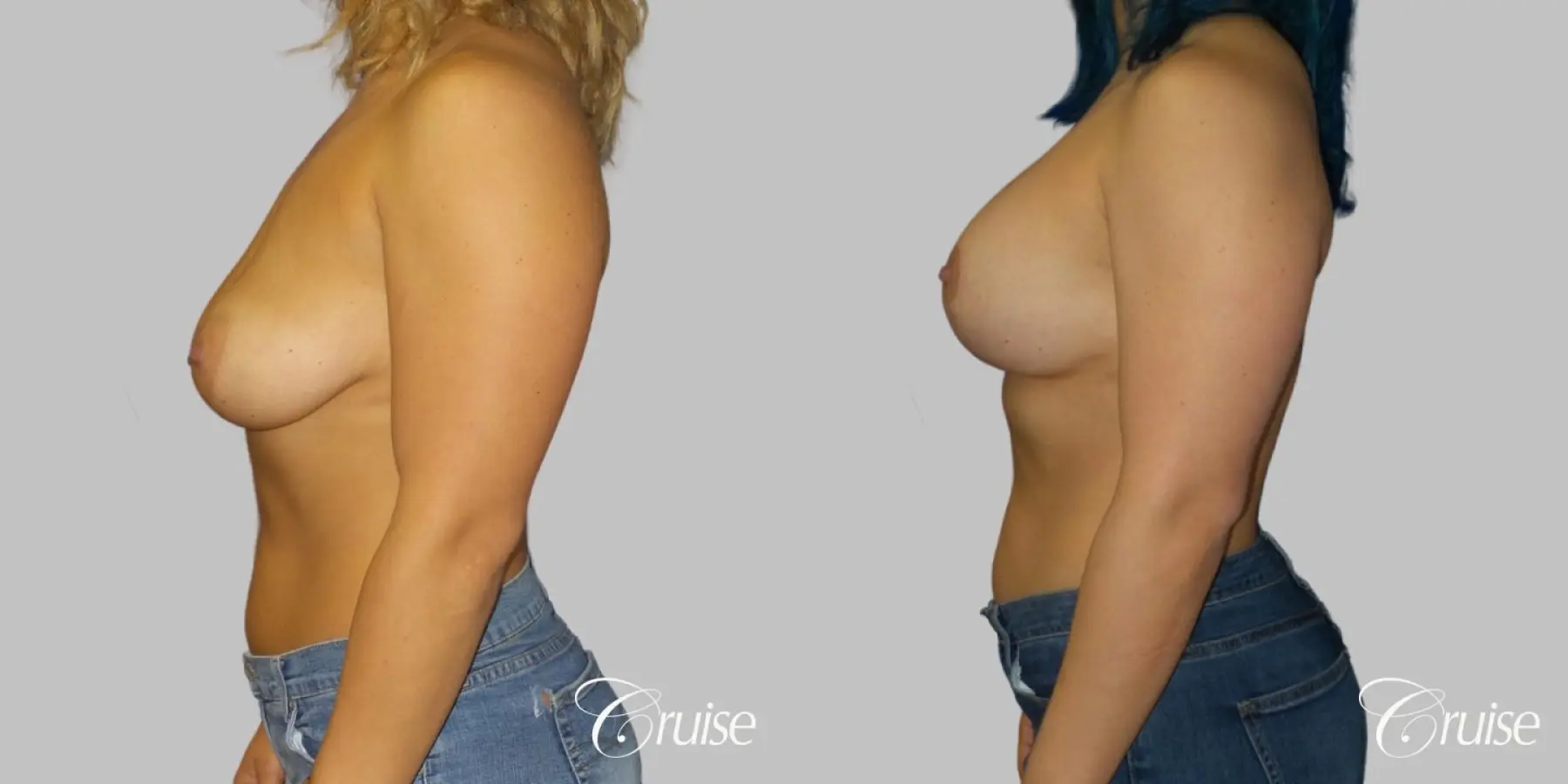 Breast Lift - Anchor with Silicone Implants - Before and After 3