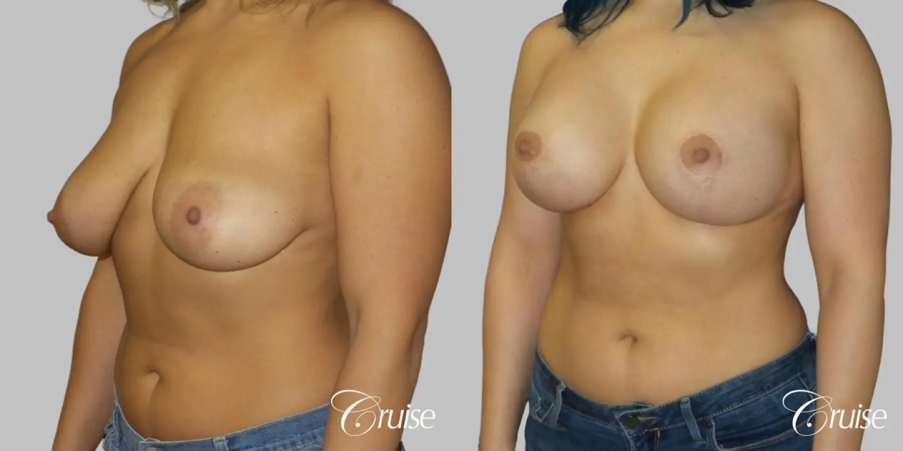 Breast Lift - Anchor with Silicone Implants - Before and After 2