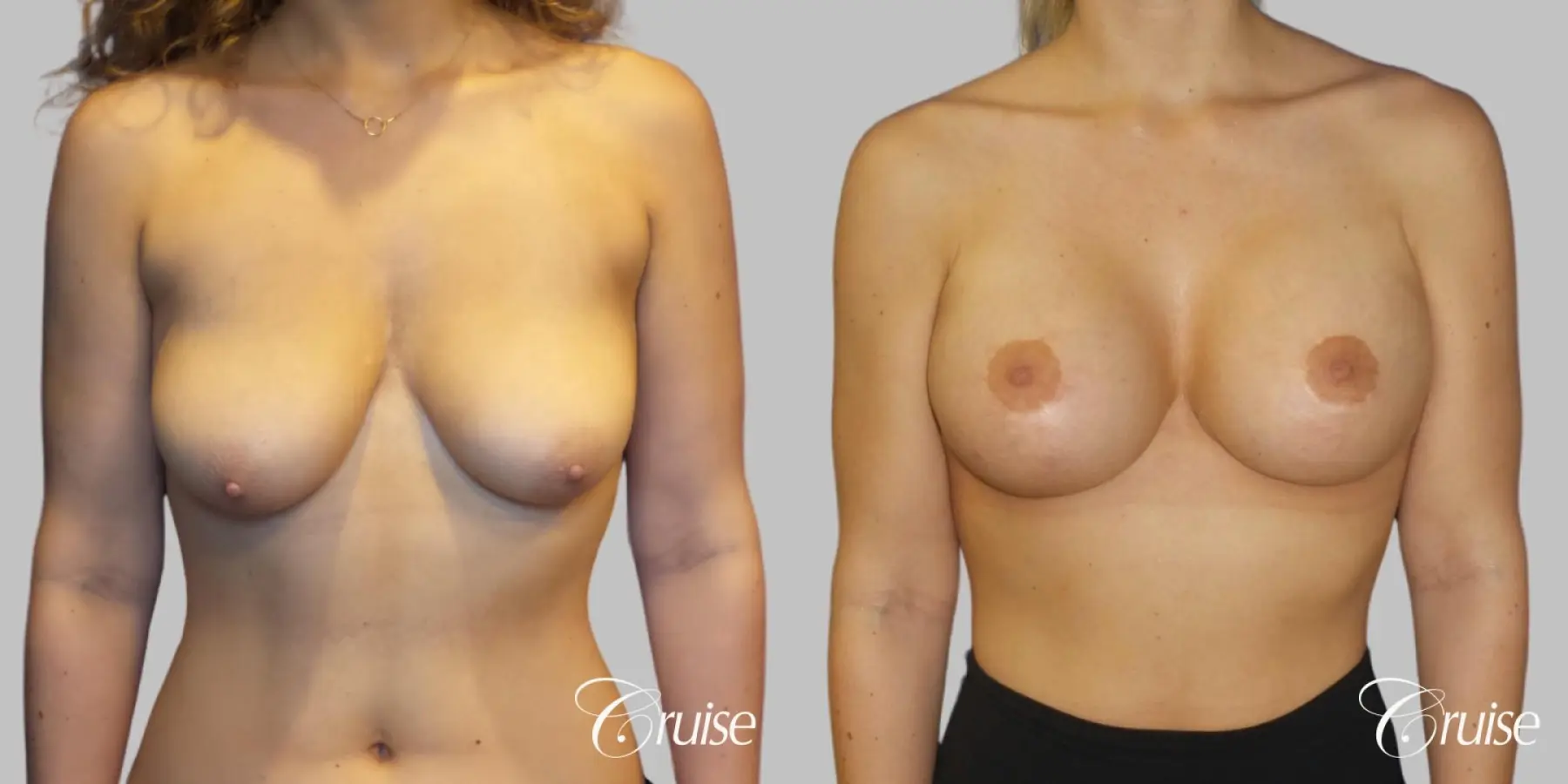 Breast Lift with Augmentation using HP Silicone 375cc - Before and After  