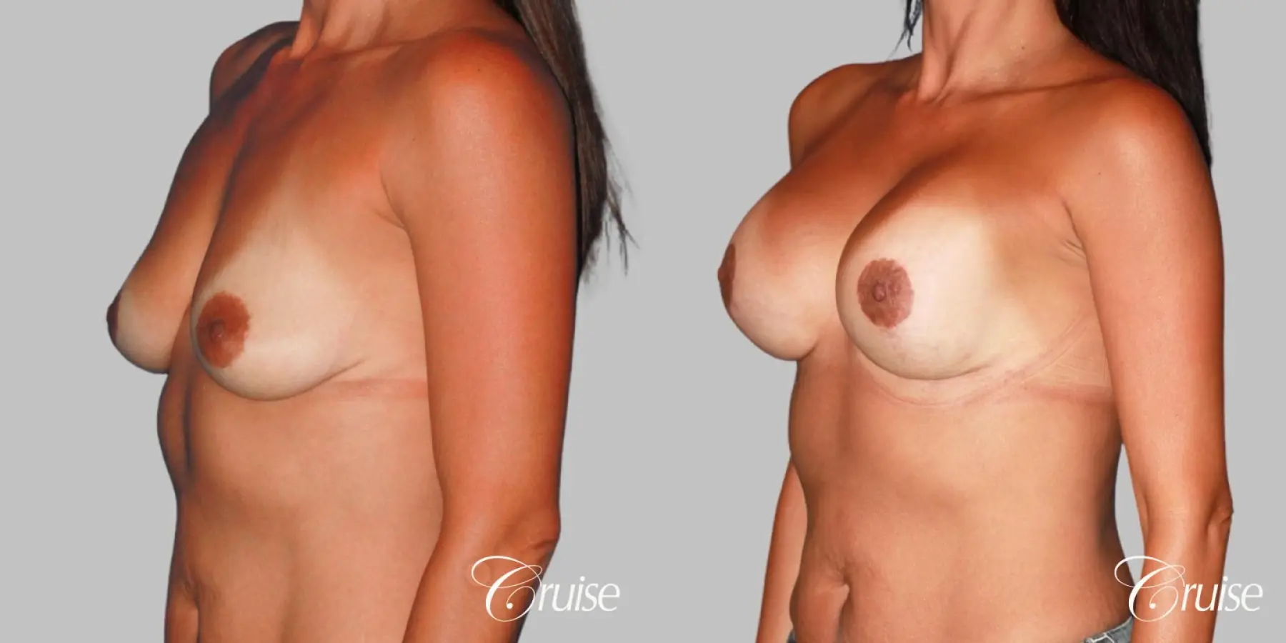 best breast lift on 41 yr old with HP silicone - Before and After 3