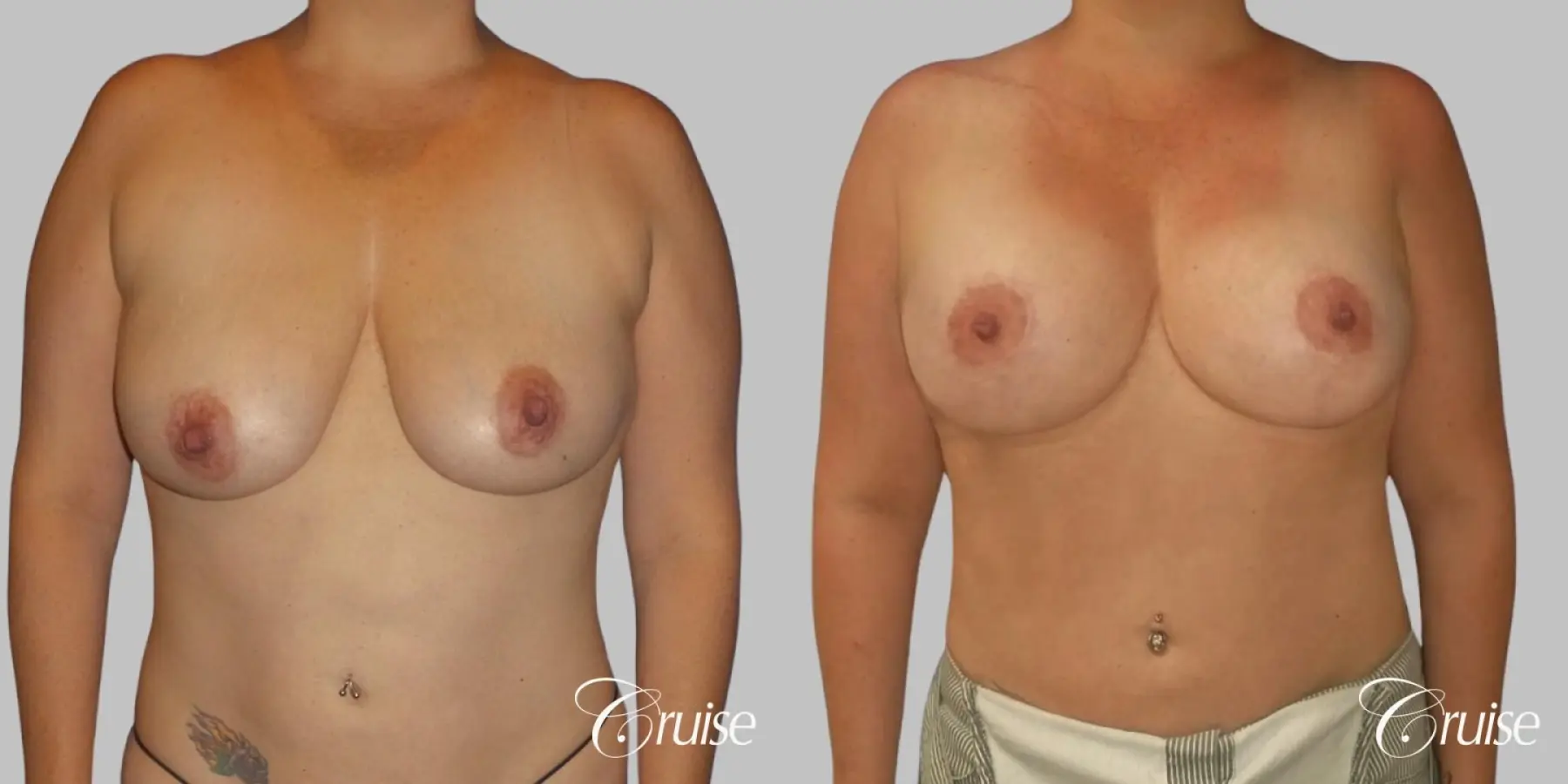 Breast Lift And Augmentation: Patient 3 - Before and After  