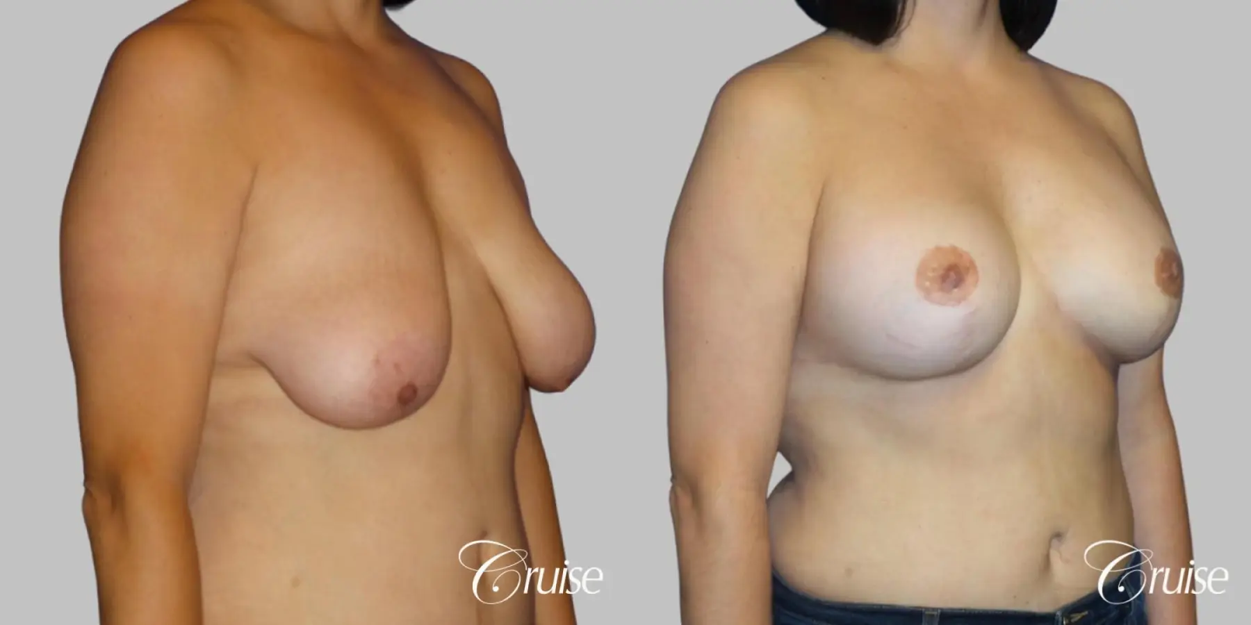 Breast Lift - Anchor with Saline Augmentation - Before and After 2