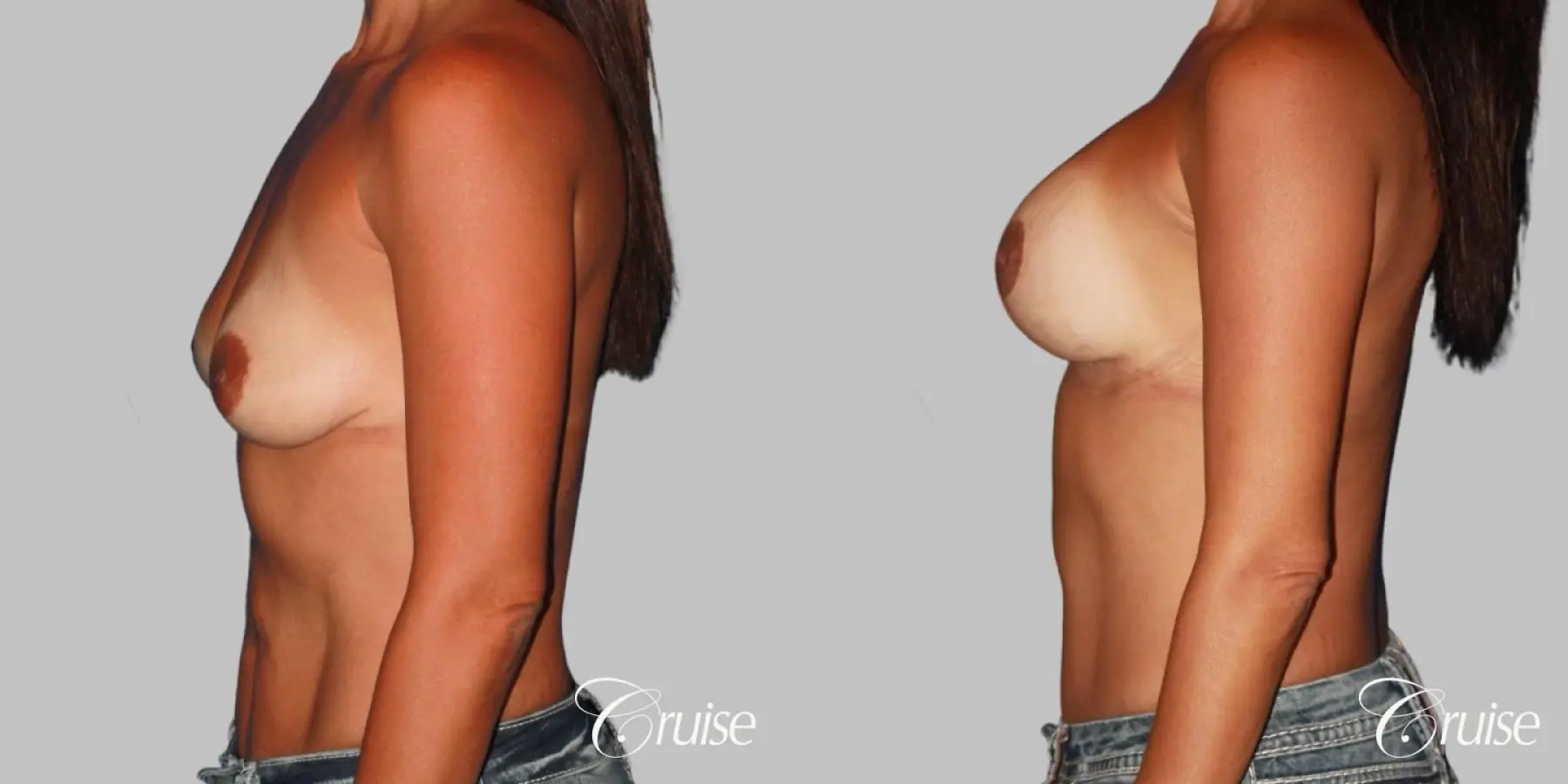 best breast lift on 41 yr old with HP silicone - Before and After 2