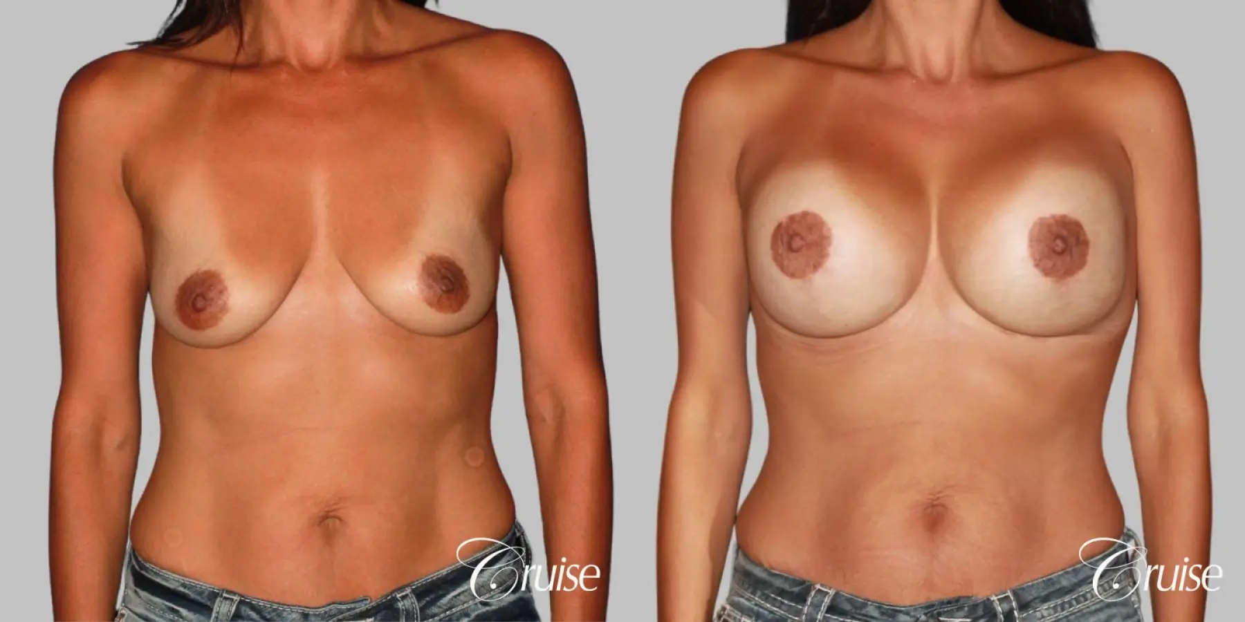 best breast lift on 41 yr old with HP silicone - Before and After