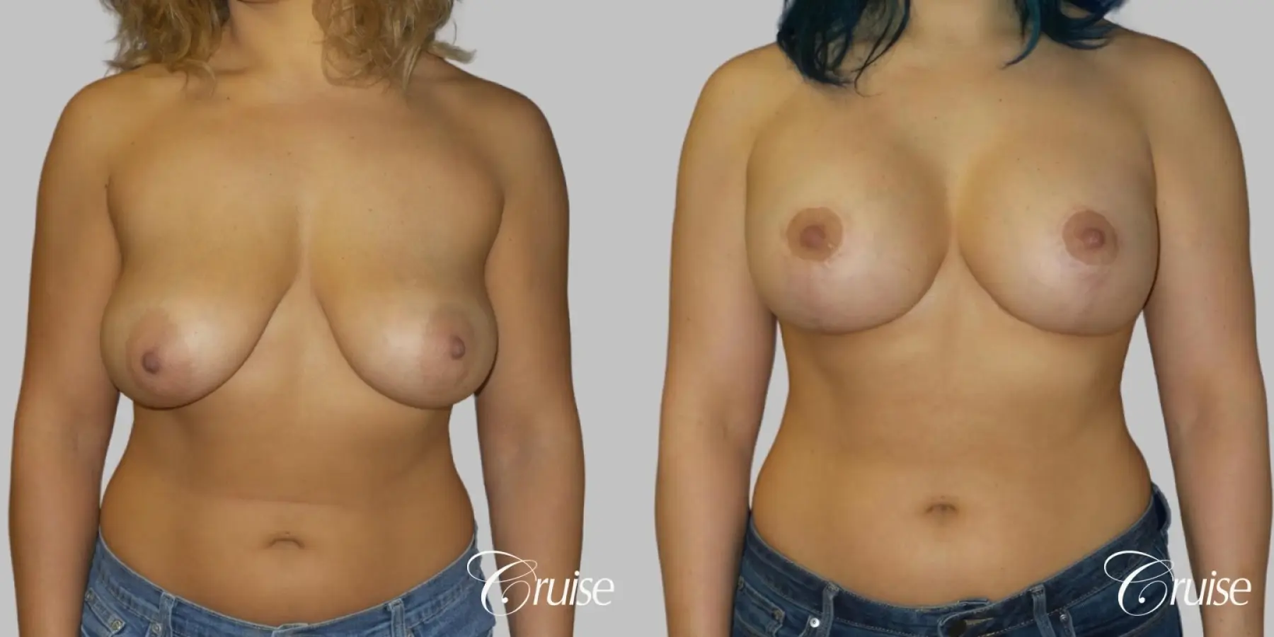 Breast Lift - Anchor with Silicone Implants - Before and After  