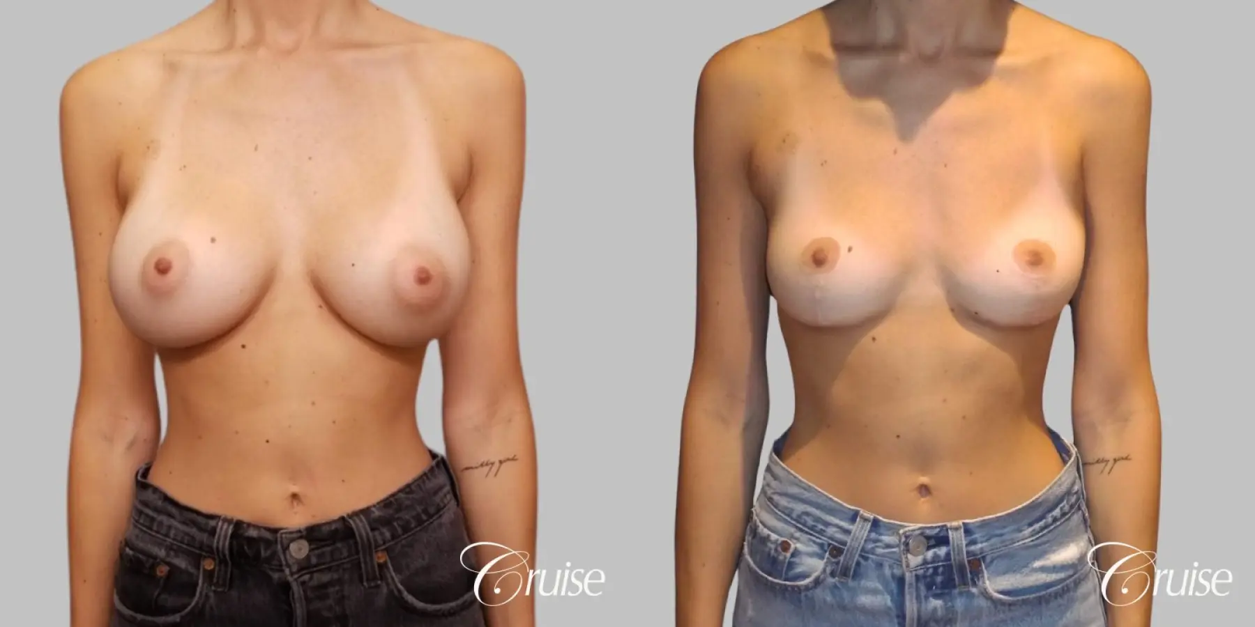 Breast Lift - Anchor with Implant Removal - Before and After  