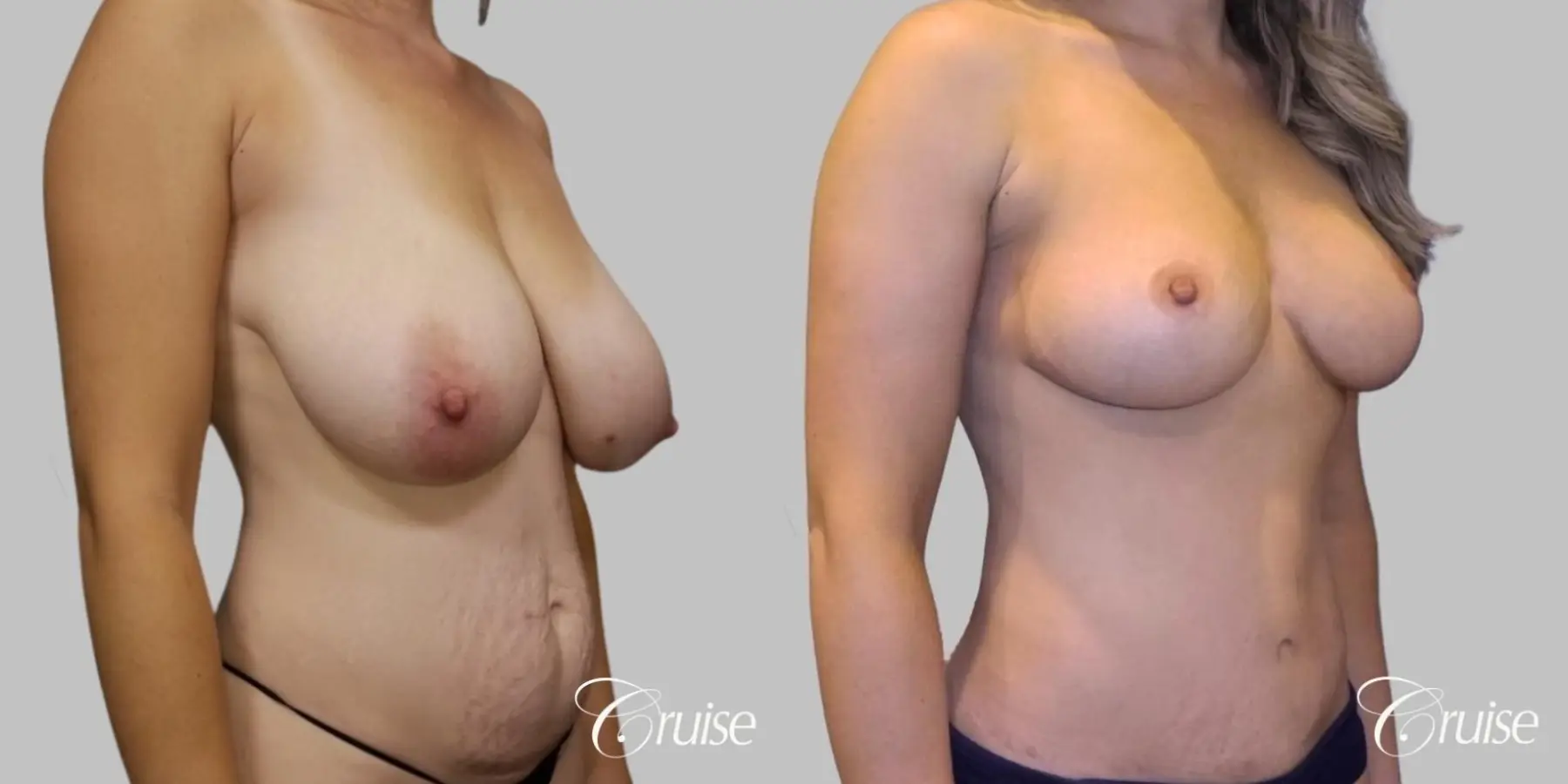 Breast Reduction: Patient 1 - Before and After 2