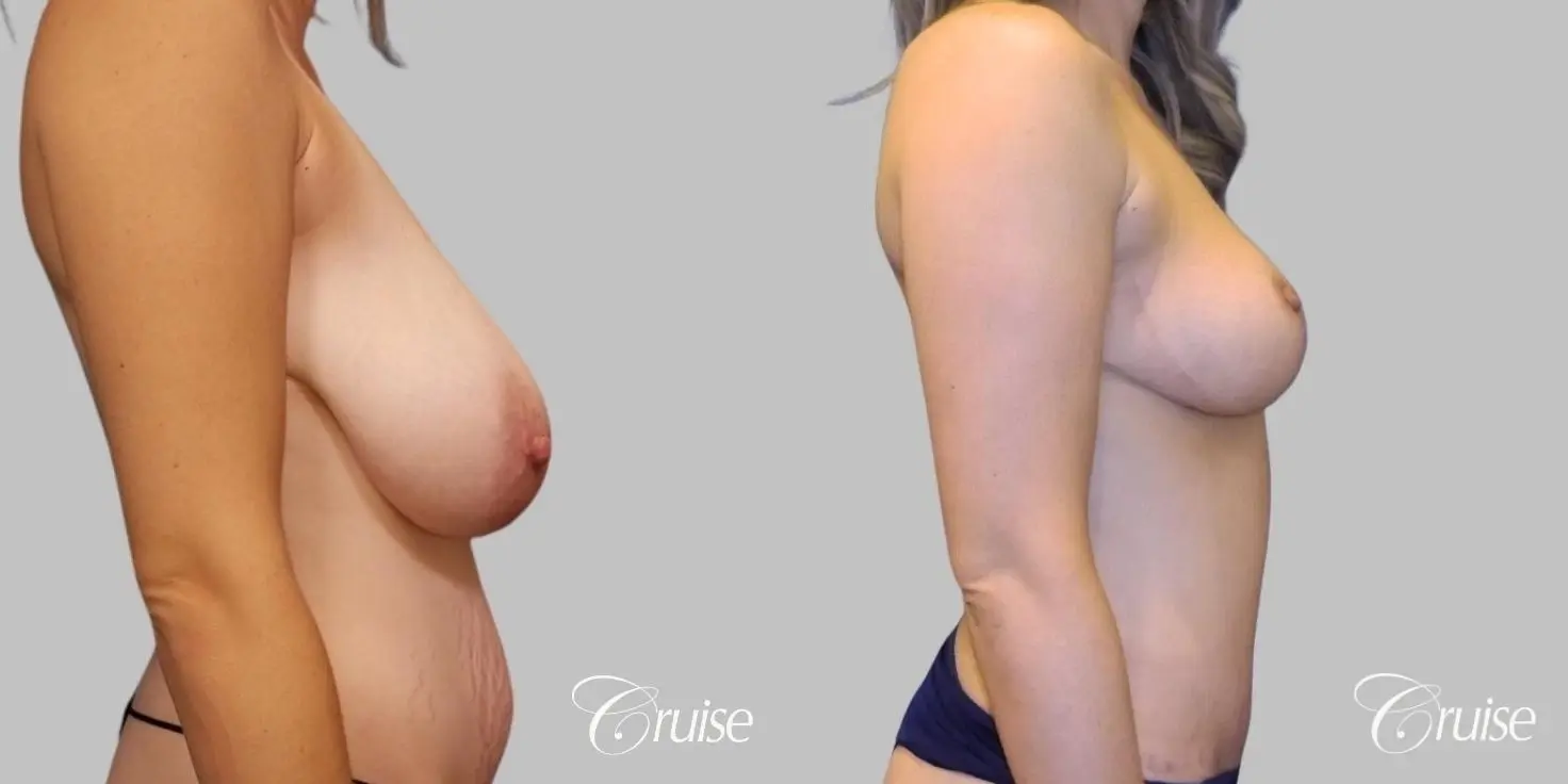 Breast Reduction: Patient 1 - Before and After 3