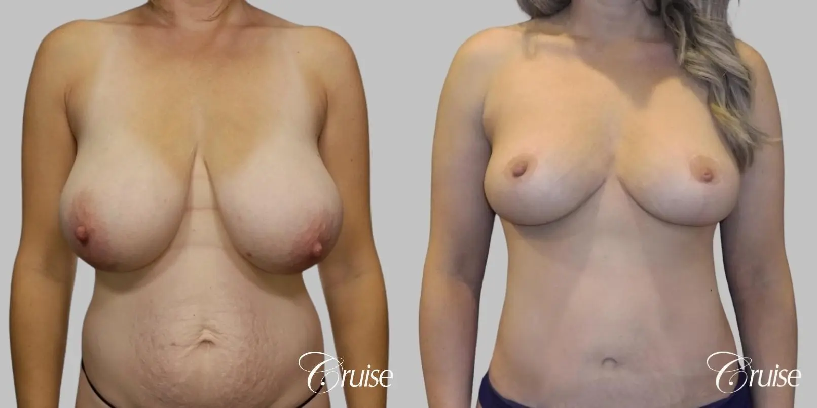 Breast Reduction: Patient 1 - Before and After 1