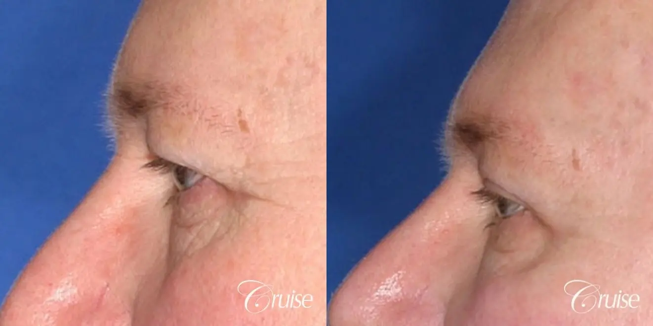 male 58 gets temple and lateral brow lift - Before and After 2