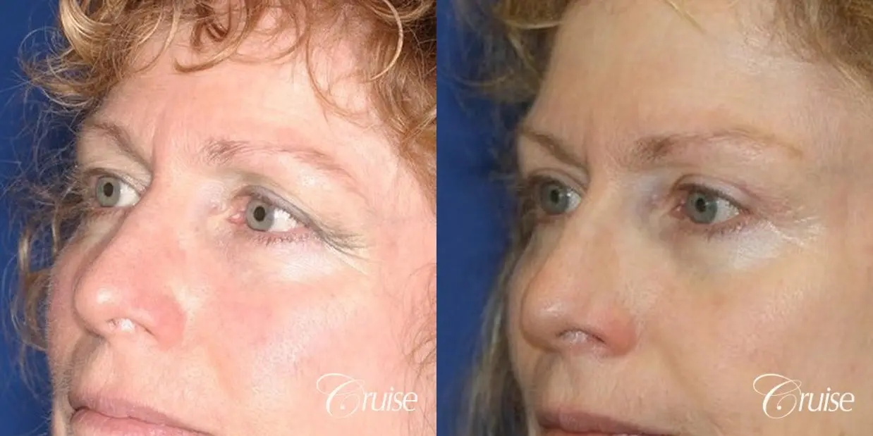 temple lift with upper blepharoplasty - Before and After 2