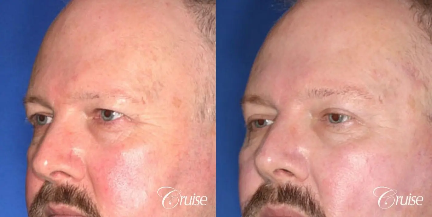 male 58 gets temple and lateral brow lift - Before and After 3