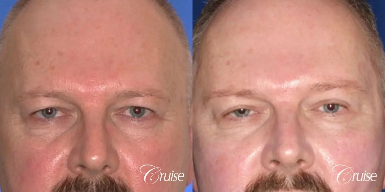 male 58 gets temple and lateral brow lift - Before and After 1