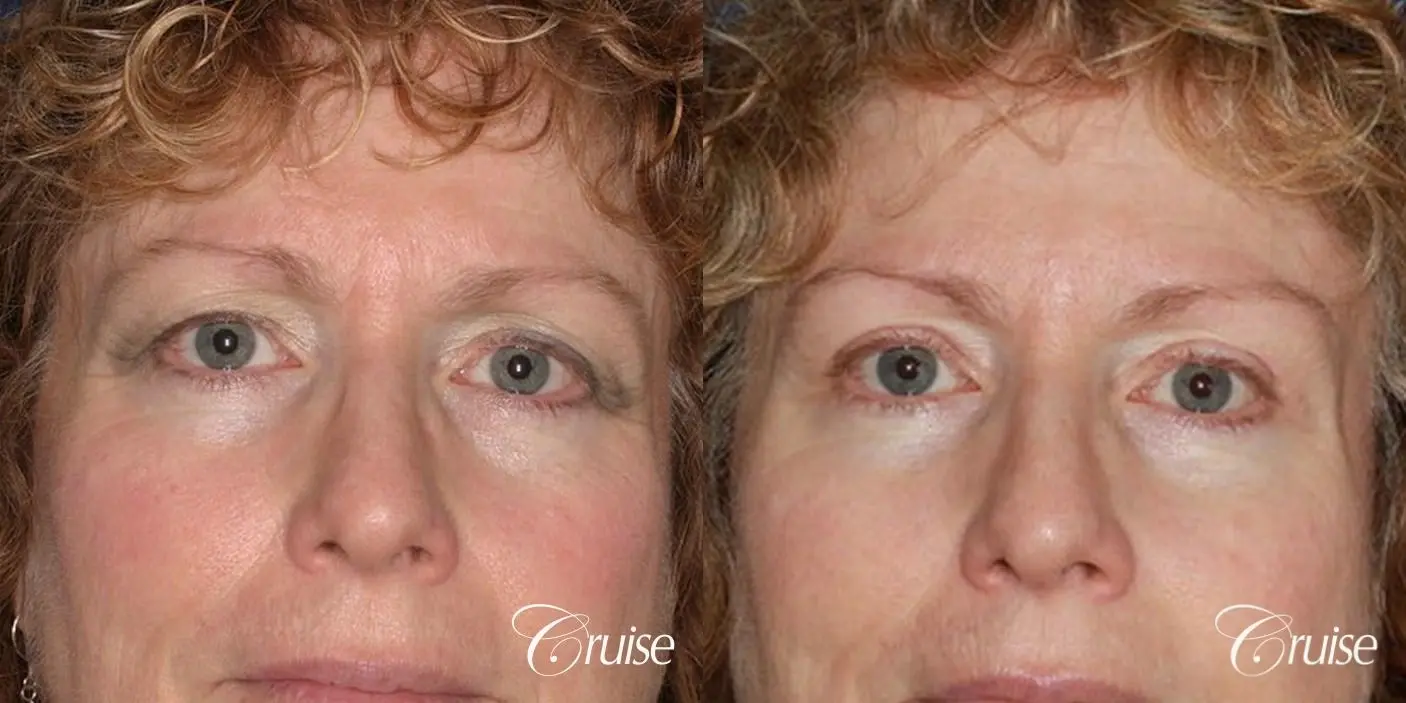 temple lift with upper blepharoplasty - Before and After 1