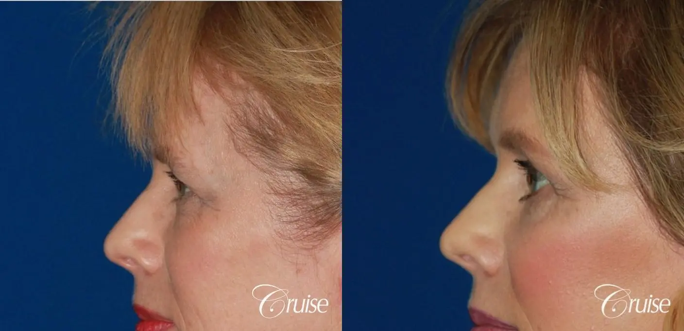 temple lift and chin implant - Before and After 2