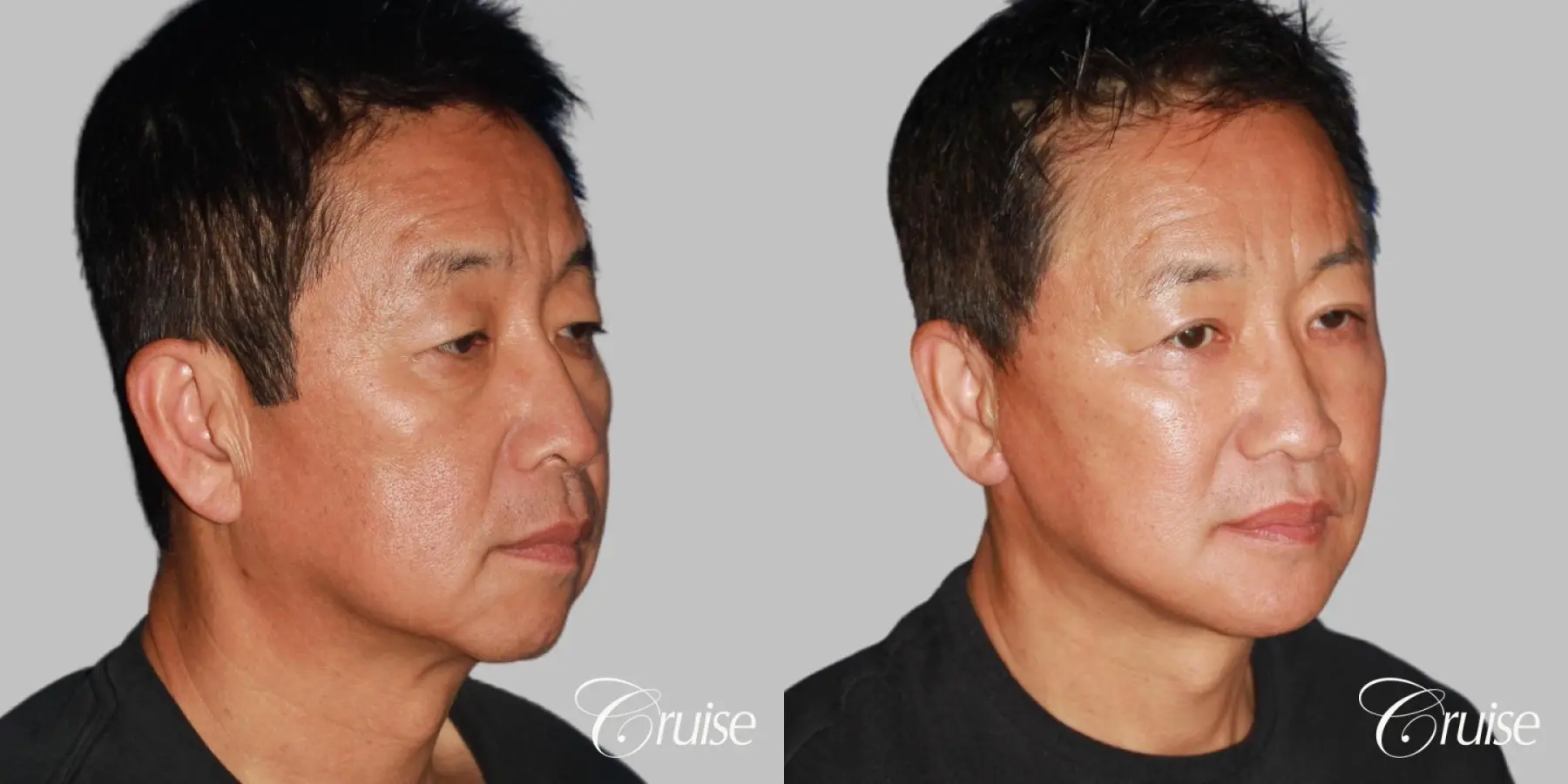 Chin Augmentation: Patient 34 - Before and After 2