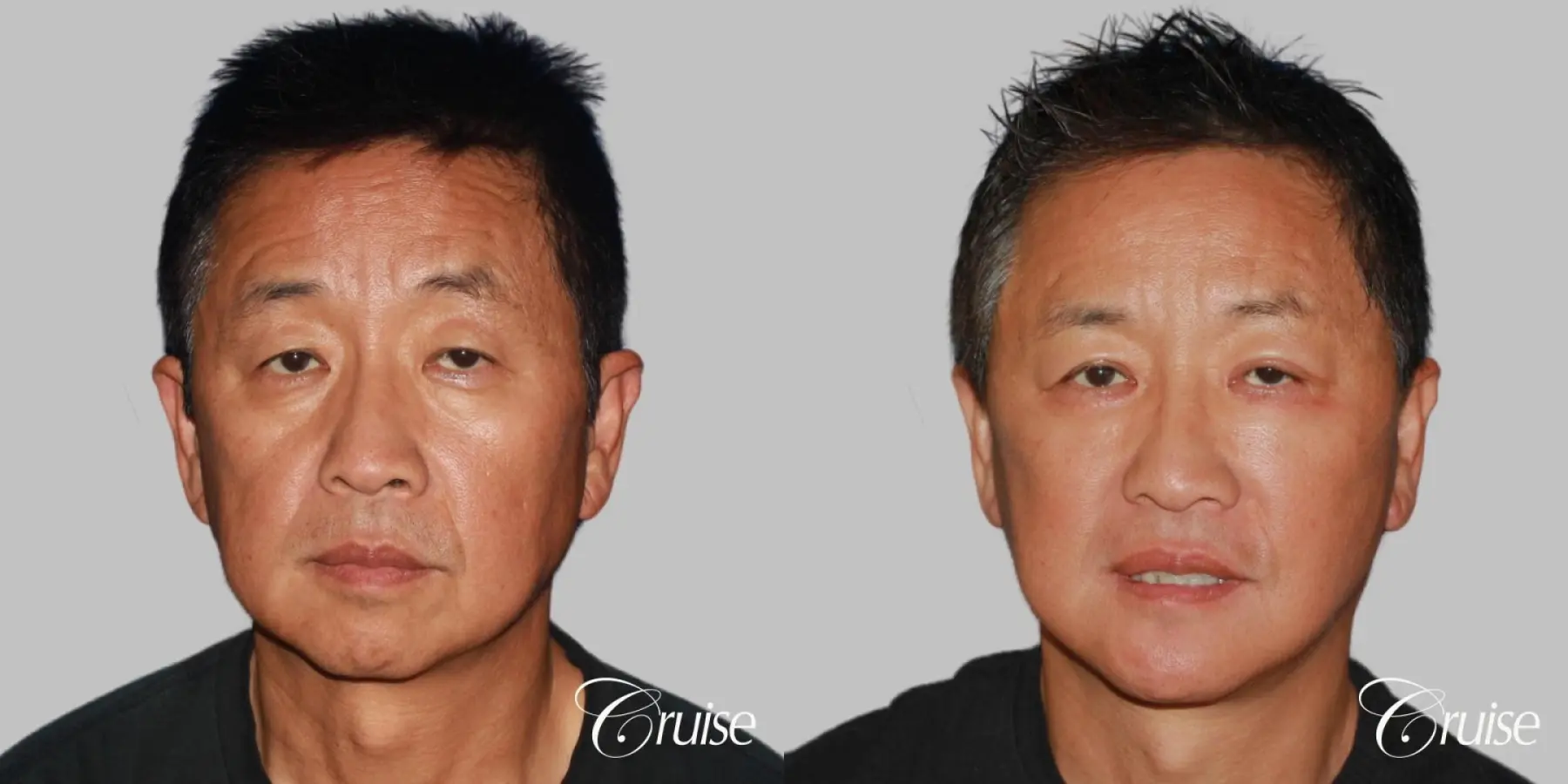 Chin Augmentation: Patient 34 - Before and After 3