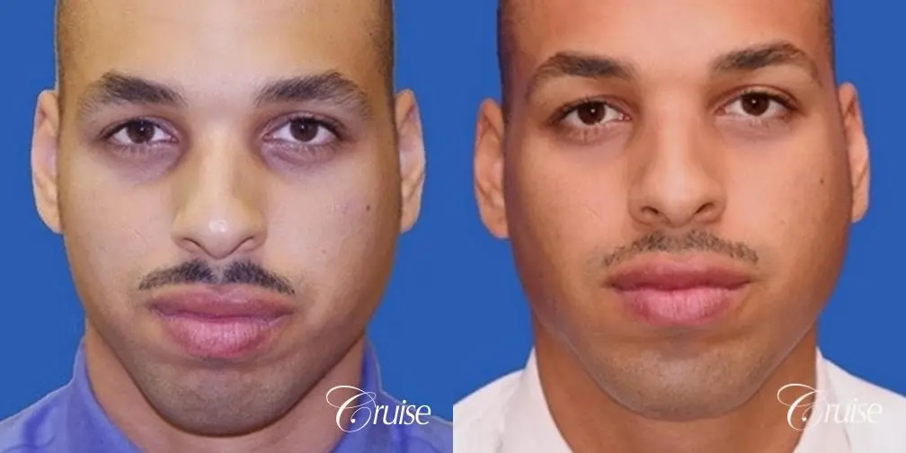 chin implant before and after