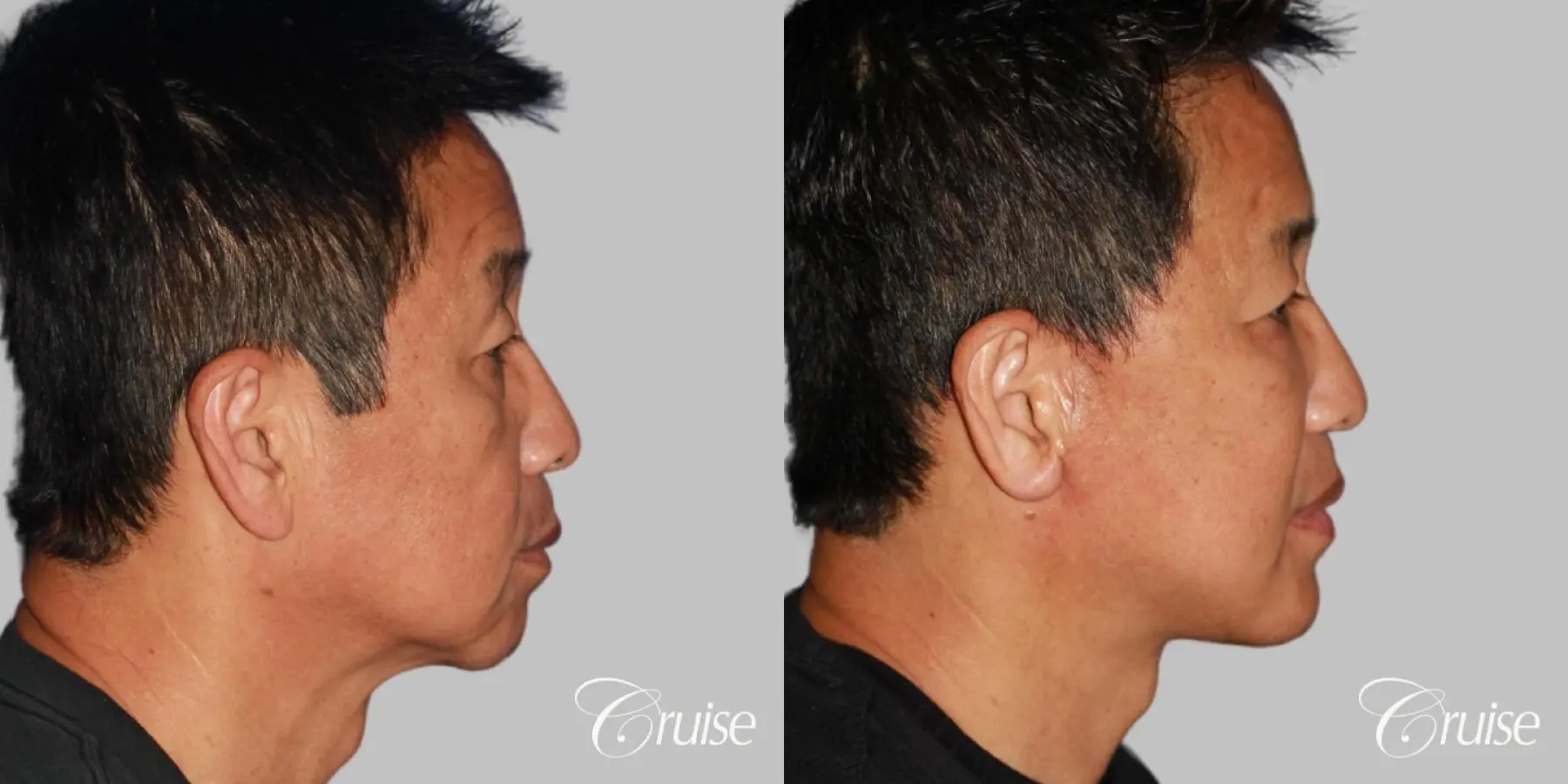 Chin Augmentation: Patient 34 - Before and After 1