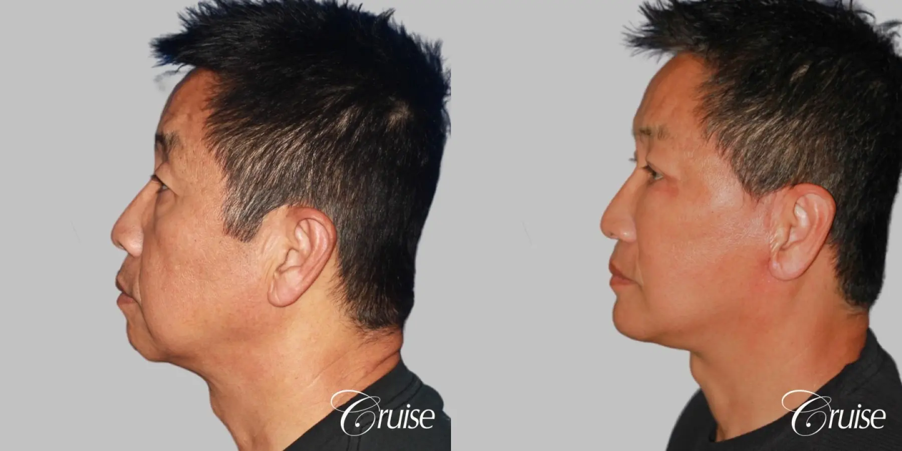 Chin Augmentation: Patient 34 - Before and After 4