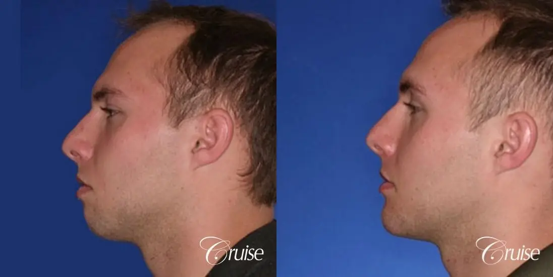 male jaw implant before and after