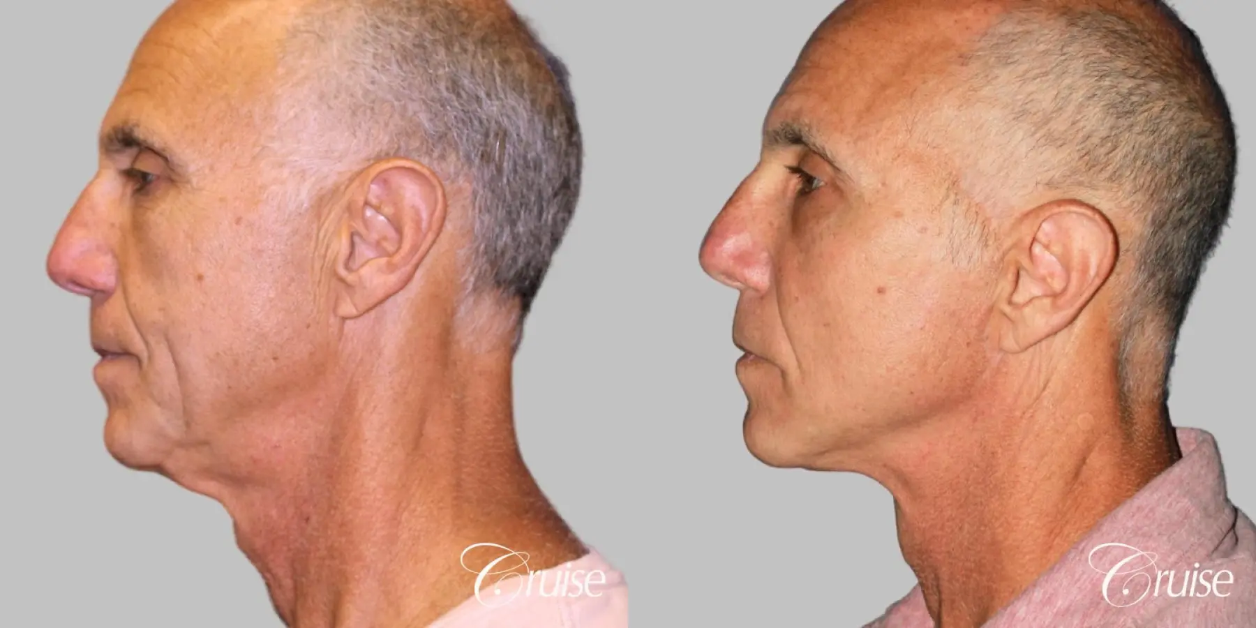 Male - Face Lift, Neck Midline Plication, Fat Transfer - Before and After 2