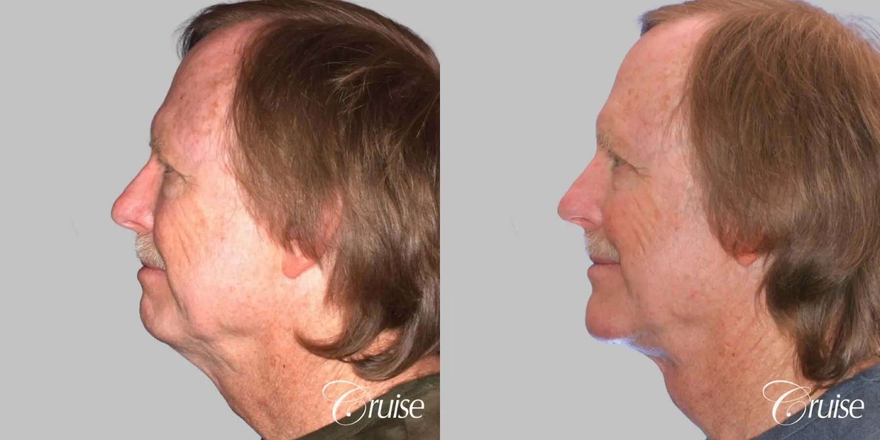 Male - Lower Face Lift, Neck Lift - Before and After 2