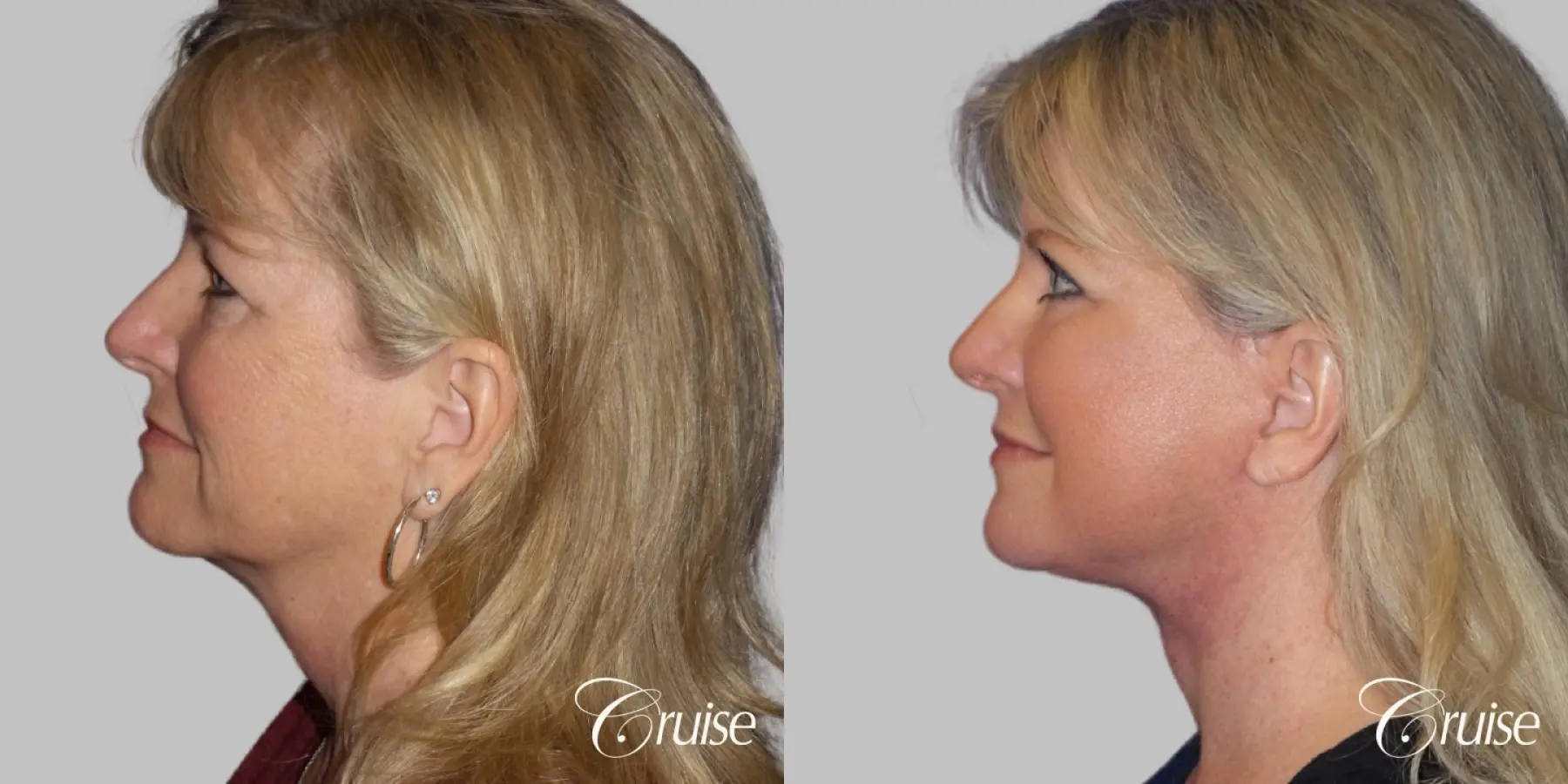 Face Lift surgery Newport Beach Orange County - Before and After 3