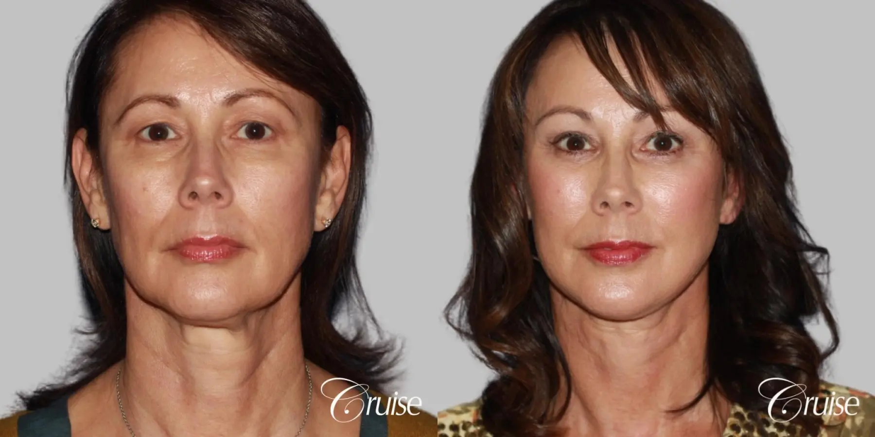 Female Facelift, Neck Midline Plication, Blepharoplasty, and Temple Lift Surgery - Before and After  