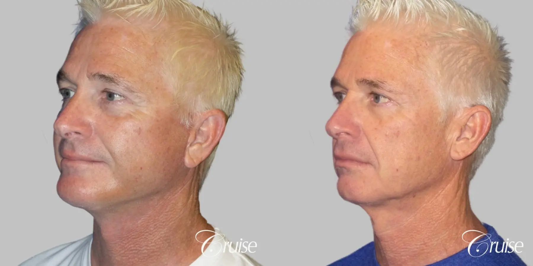 Male neck lift before and after - Before and After 2