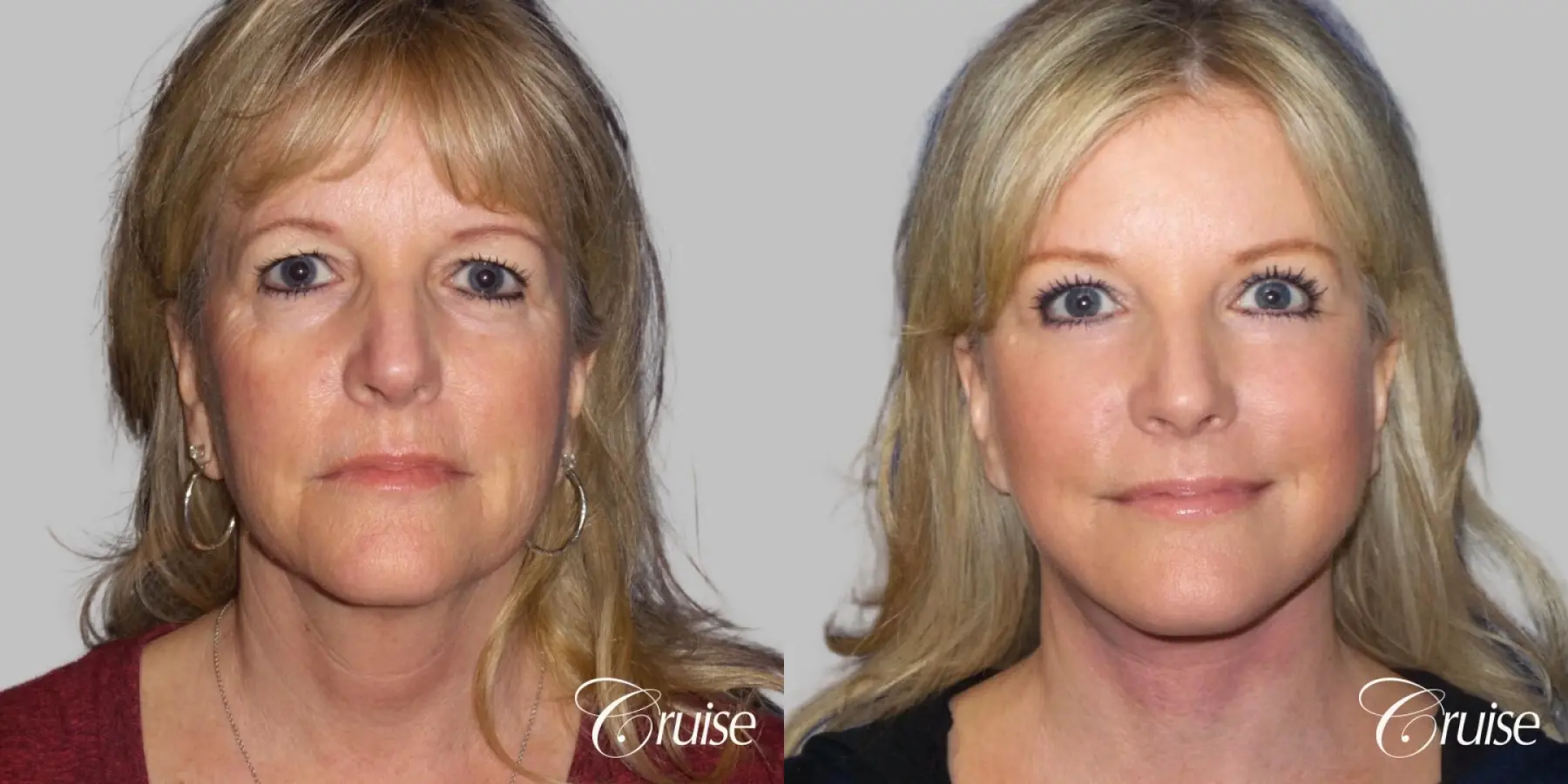 Face Lift surgery Newport Beach Orange County - Before and After