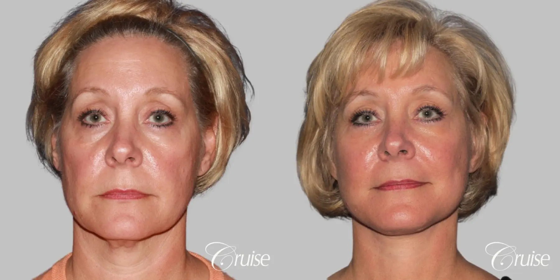 Female Facelift, Temple Lift, Fat Transfer, Neck Lift - Before and After 1