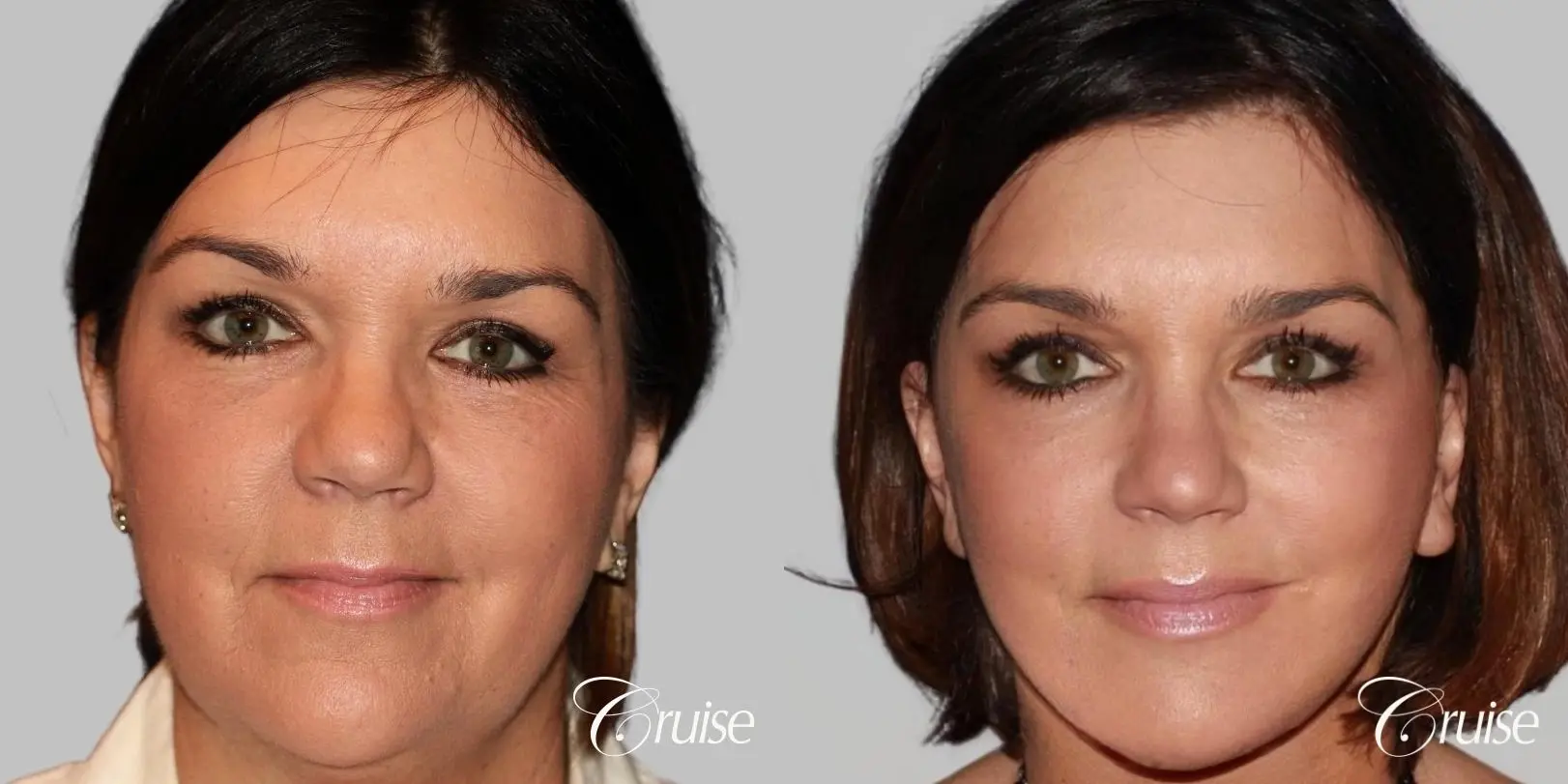 midface with lower face and neck lift orange county - Before and After 1