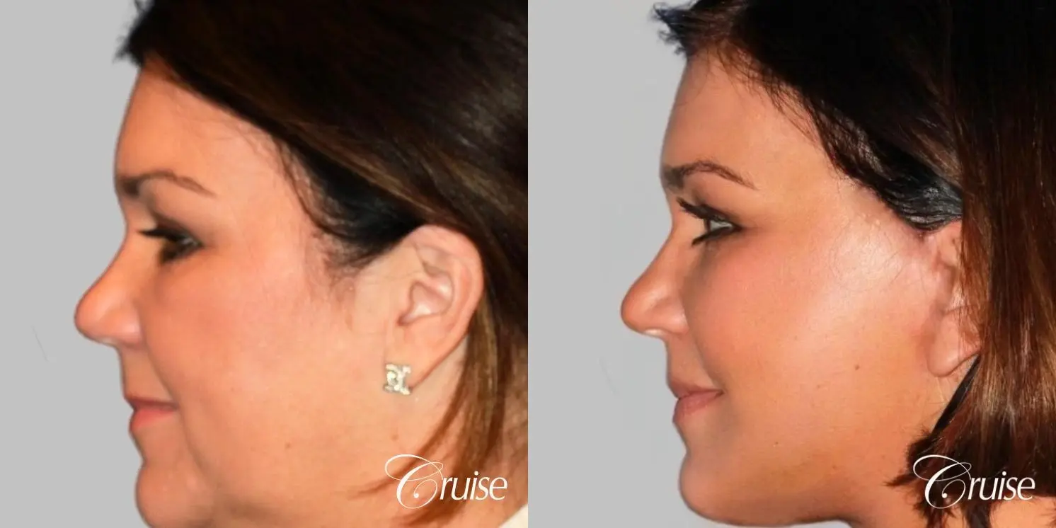 midface with lower face and neck lift orange county - Before and After 3