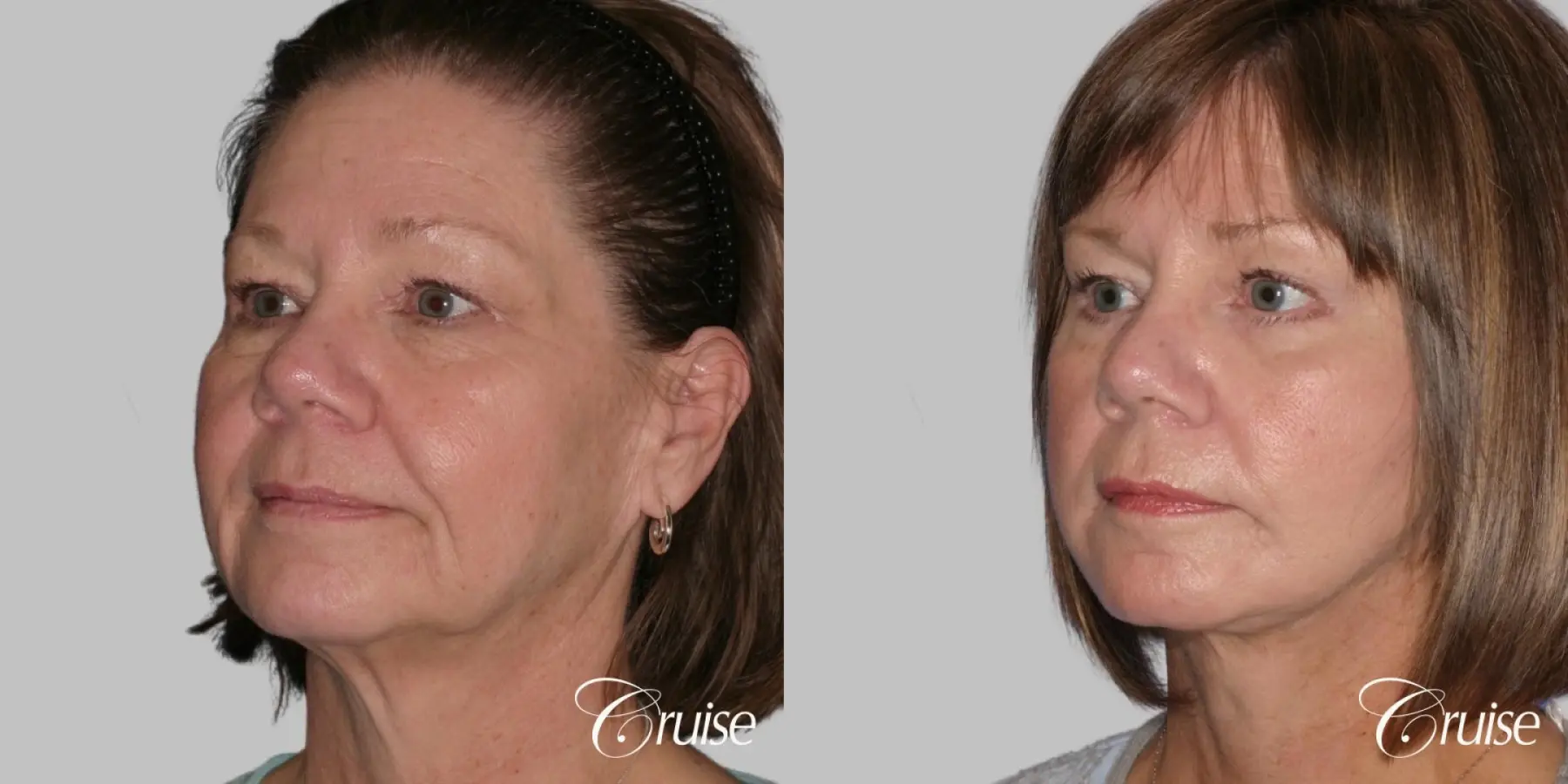 Female Facelift, Necklift, Temple Lift, Lower Eyelid Surgery - Before and After 2