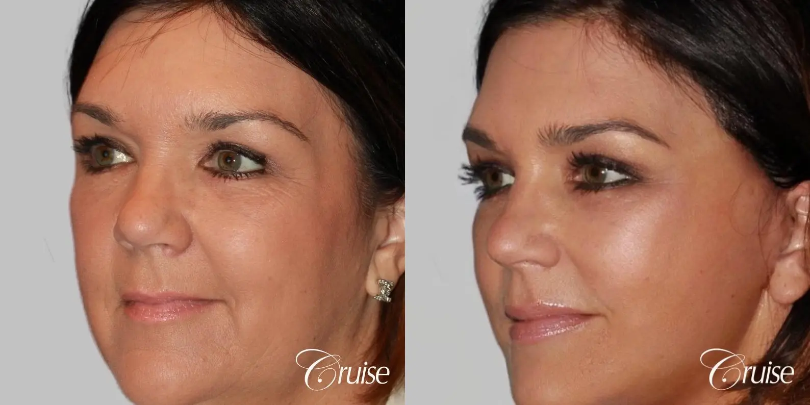 midface with lower face and neck lift orange county - Before and After 2