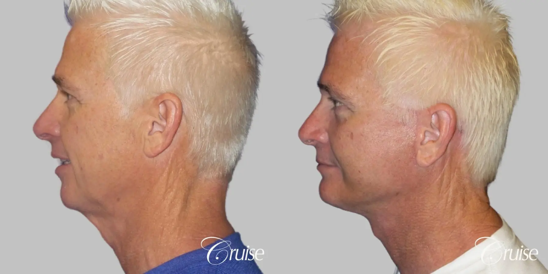 Male neck lift before and after - Before and After 3