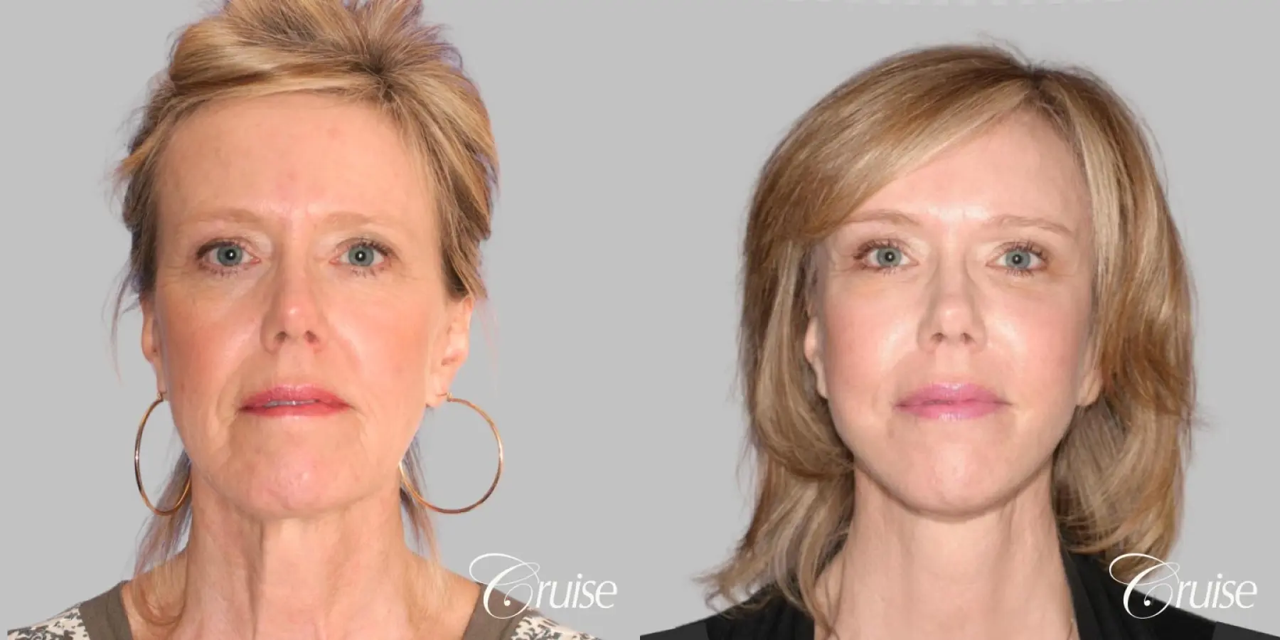 Female Facelift, NeckLift, Neck Midline Plication, Fat Transfer - Before and After 1