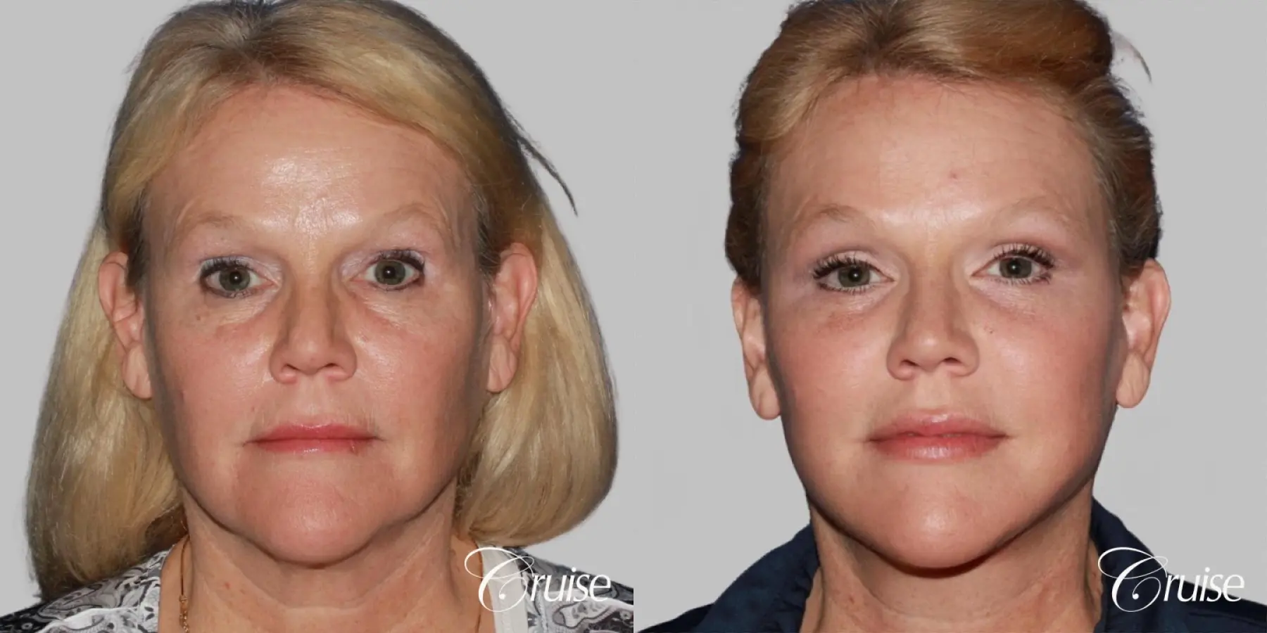 Facelift in Newport Beach, CA - Before and After