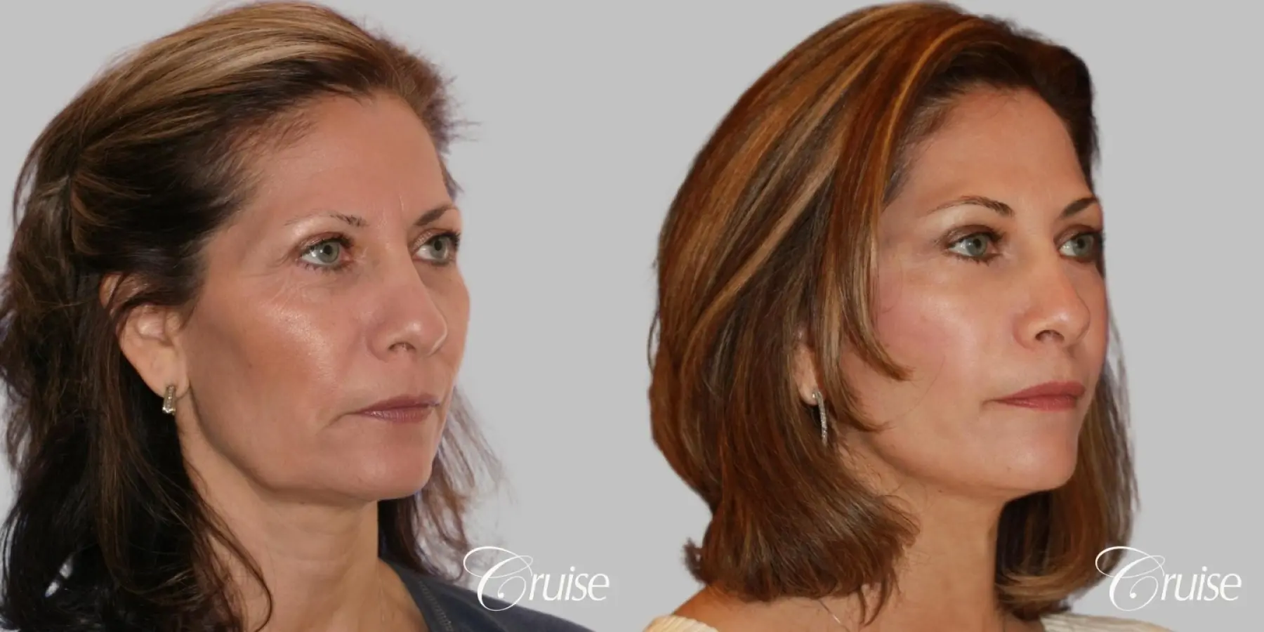 Face Lift, Fat Transfer, Temple Lift - Before and After 3