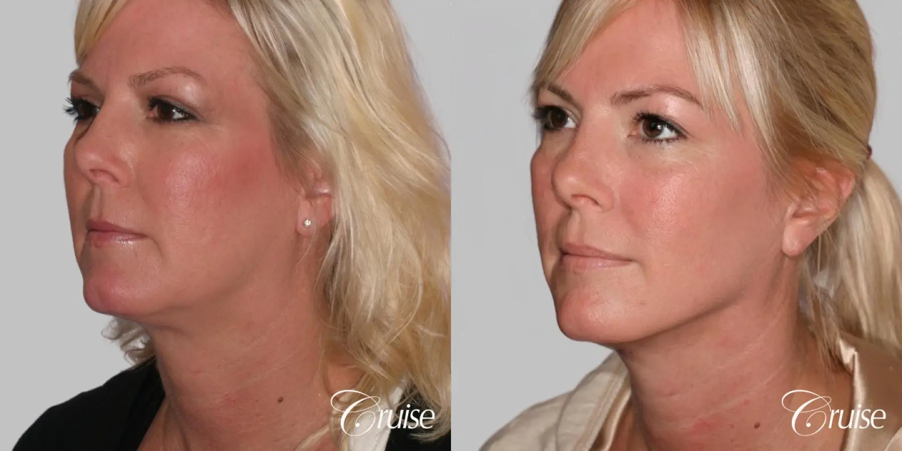 Facelift, Necklift, Lipo Neck and Jawline - Before and After 2