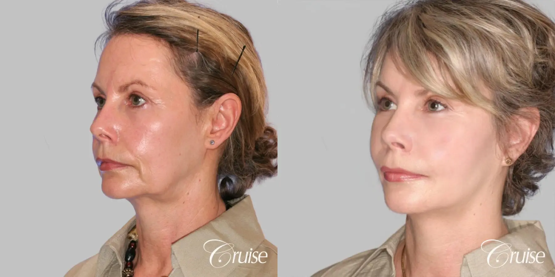 Facelift in Newport Beach, CA - Before and After 3