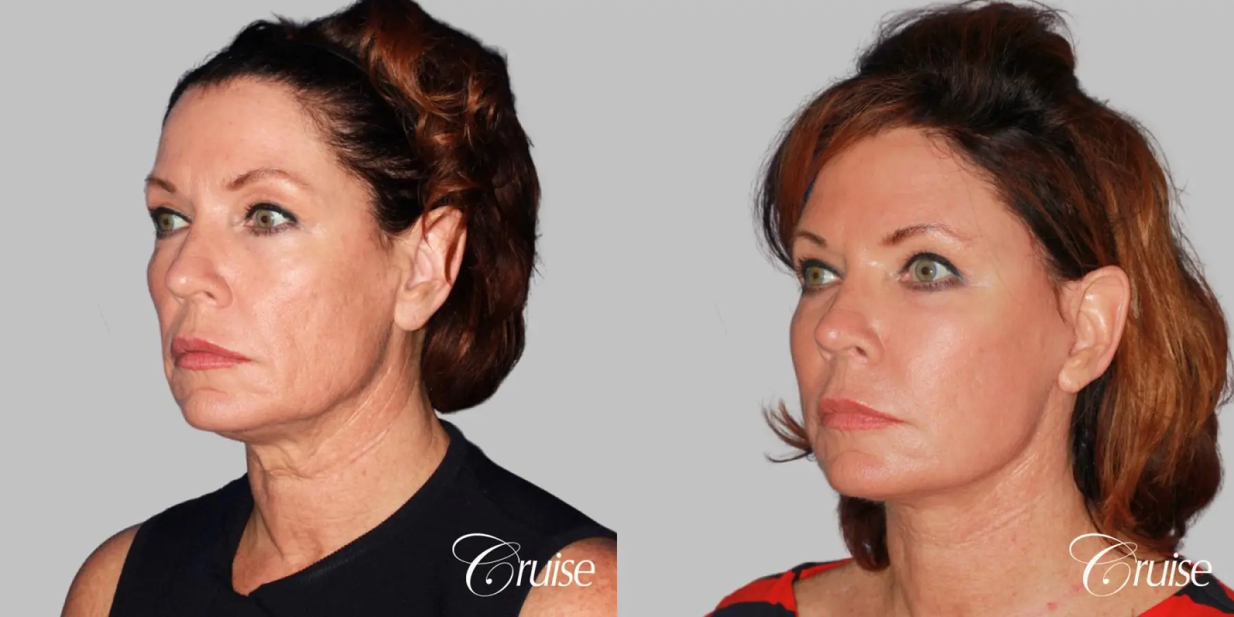 lower face and neck lift dr. joseph cruise - Before and After 3