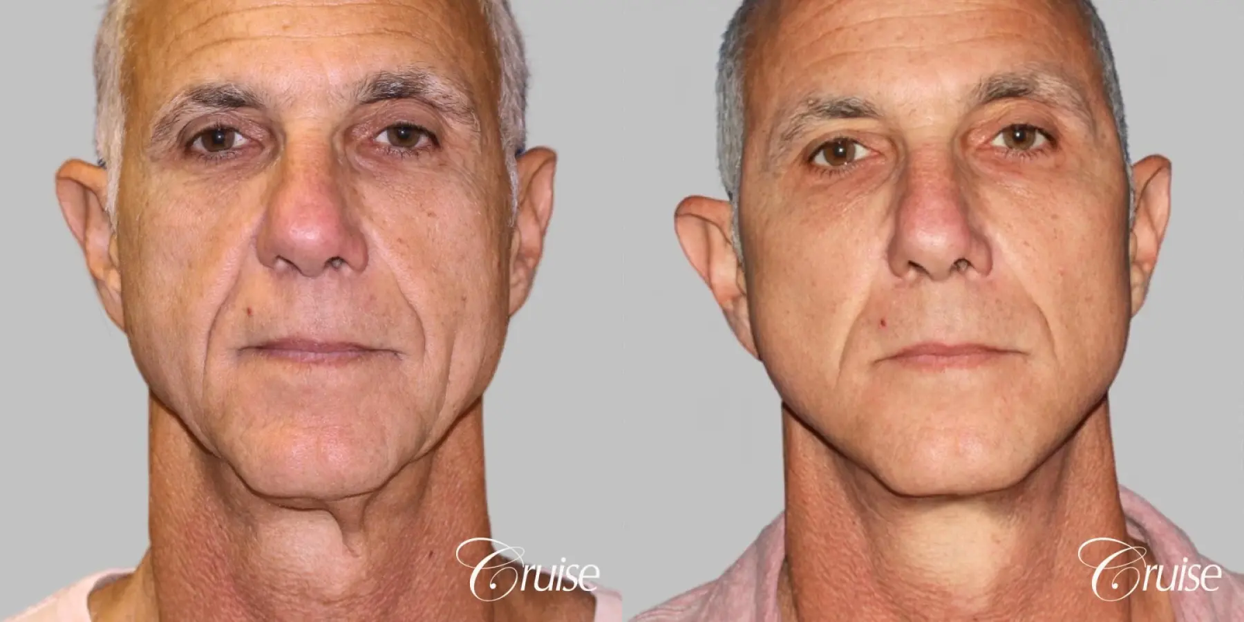 Male - Face Lift, Neck Midline Plication, Fat Transfer - Before and After 1