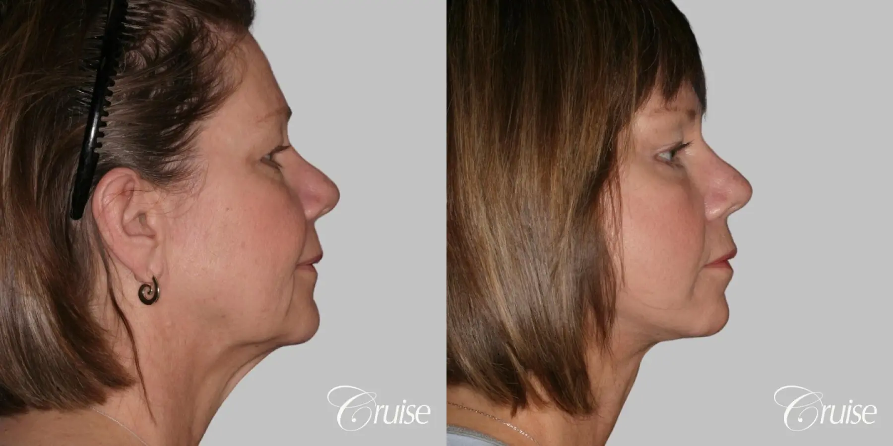 Female Facelift, Necklift, Temple Lift, Lower Eyelid Surgery - Before and After 3