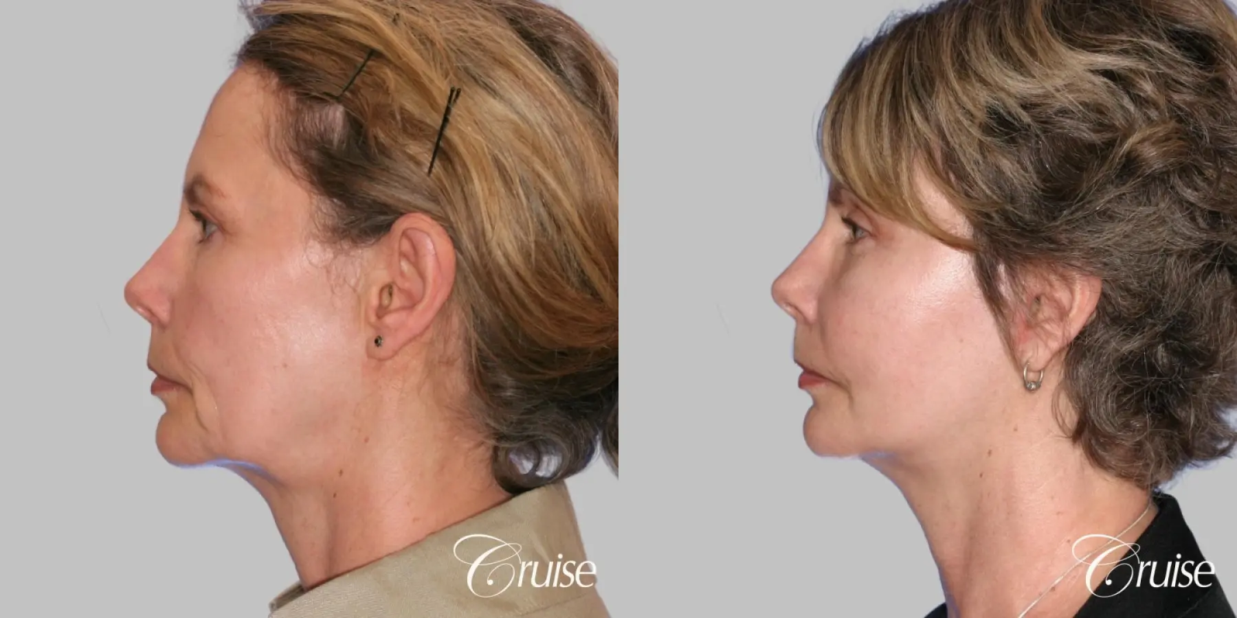 Facelift in Newport Beach, CA - Before and After 2