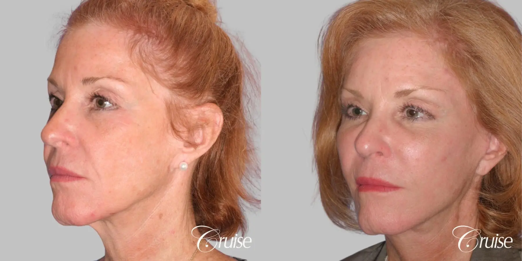 Facelift, Necklift, Temple Lift, Fat Transfer - Before and After 2