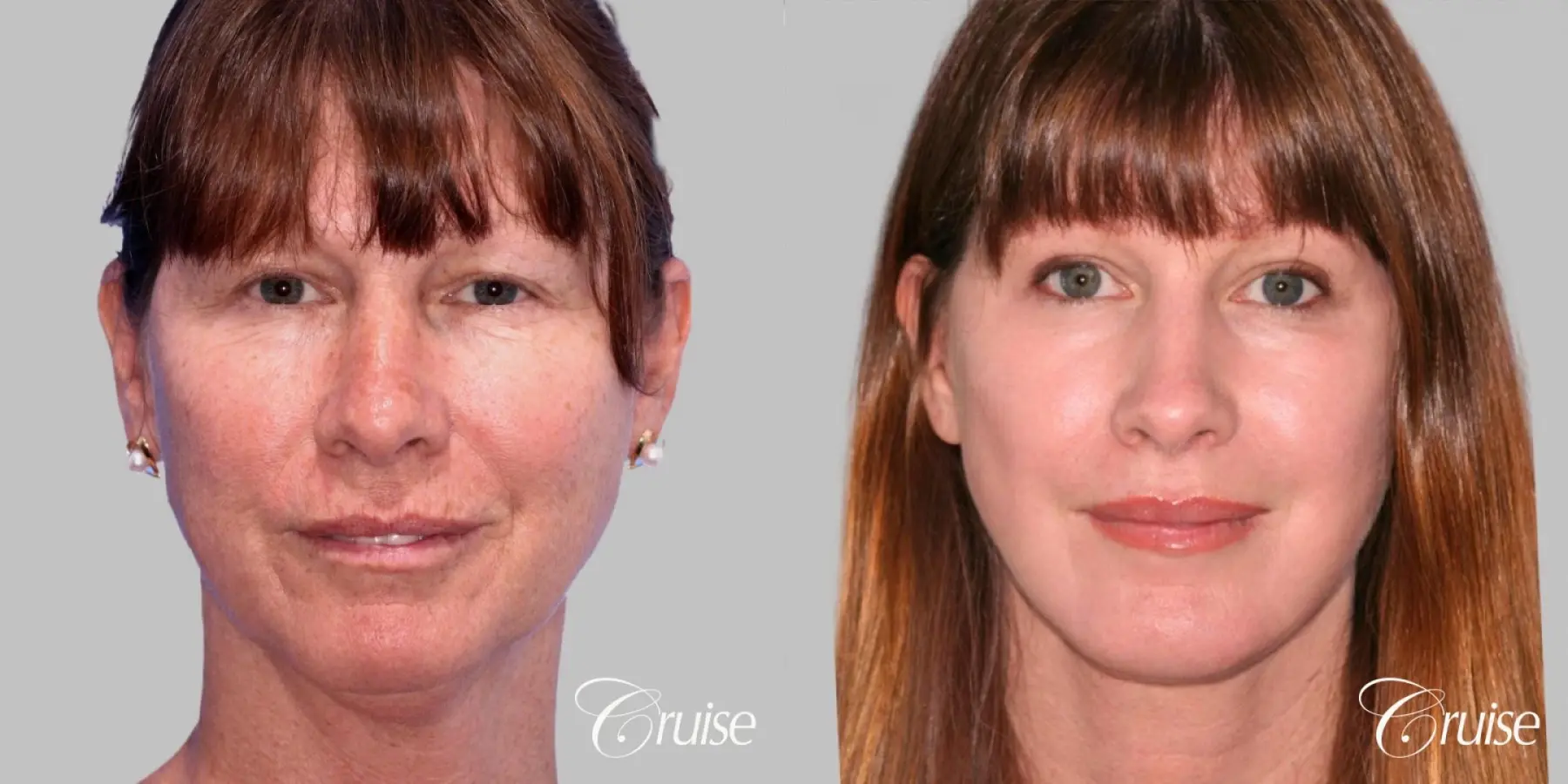 Facelift in Newport Beach, CA - Before and After 1