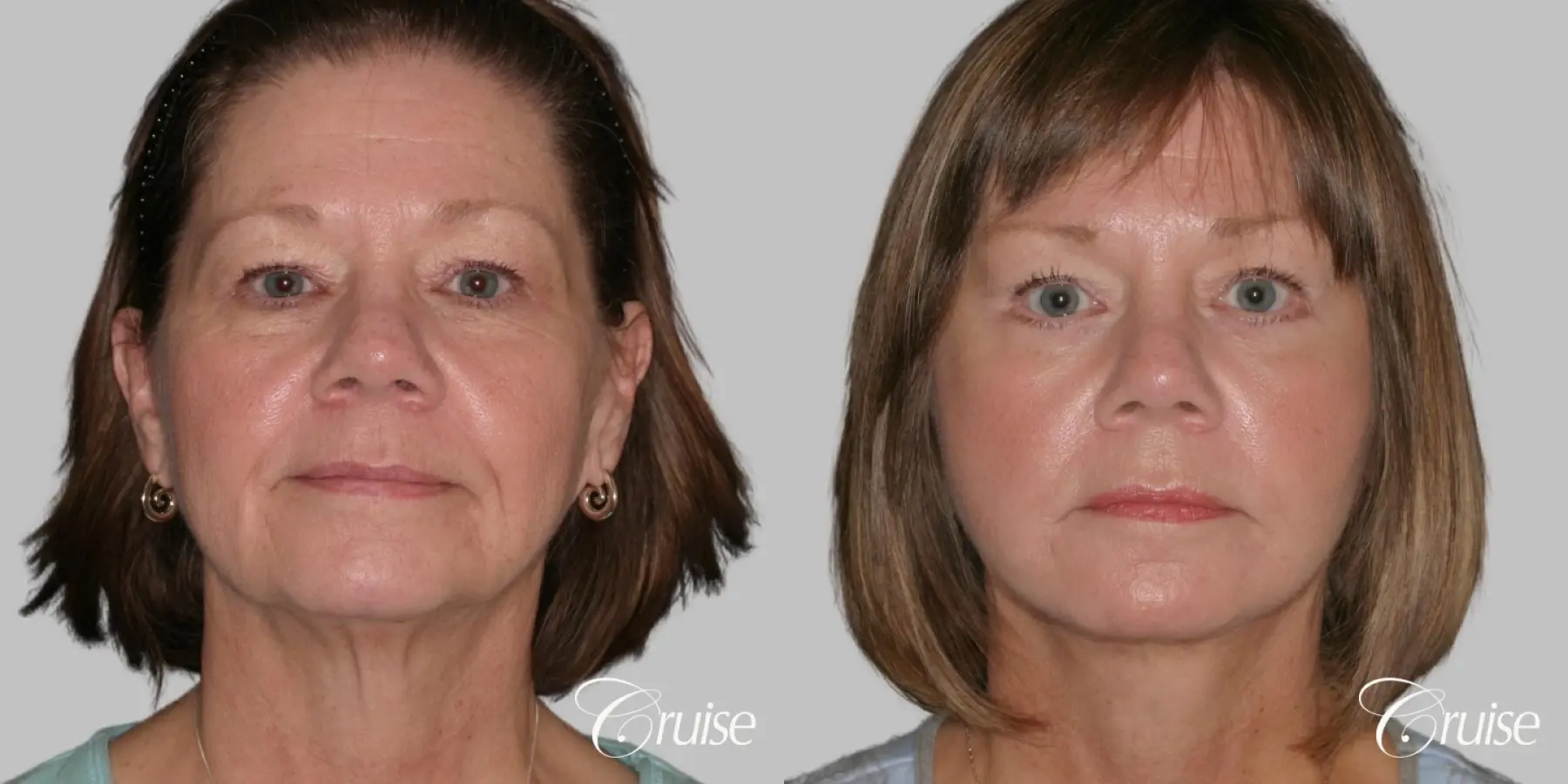 Female Facelift, Necklift, Temple Lift, Lower Eyelid Surgery - Before and After 1